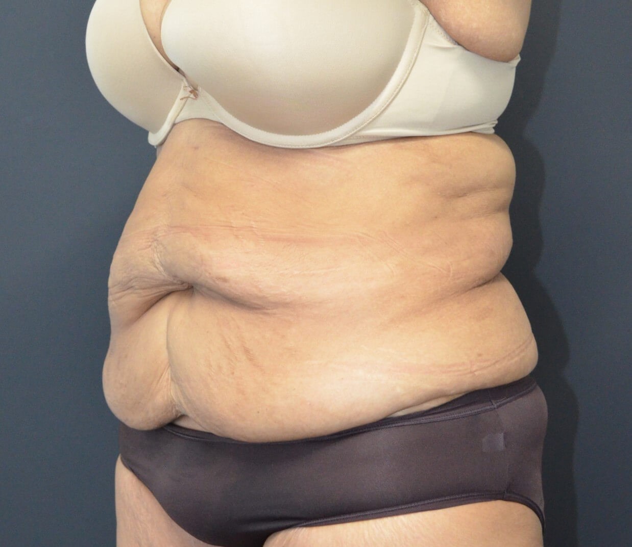 Lipoabdominoplasty Before