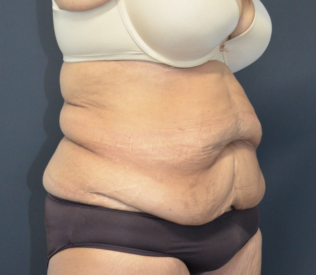 Lipoabdominoplasty Before