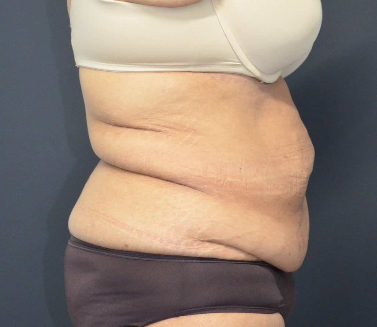 Lipoabdominoplasty Before