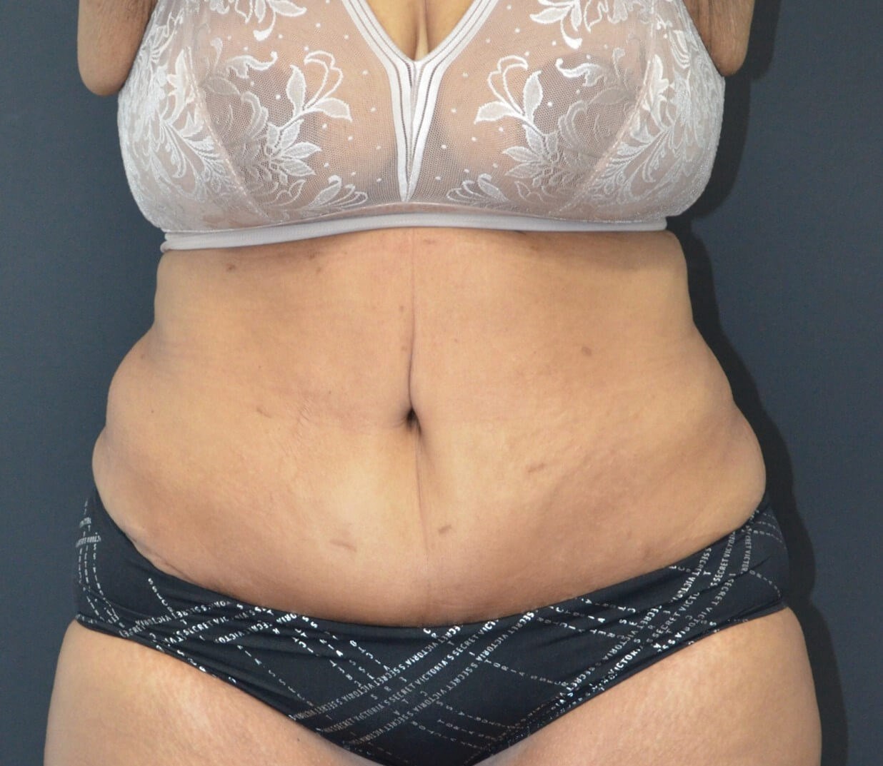 Lipoabdominoplasty After