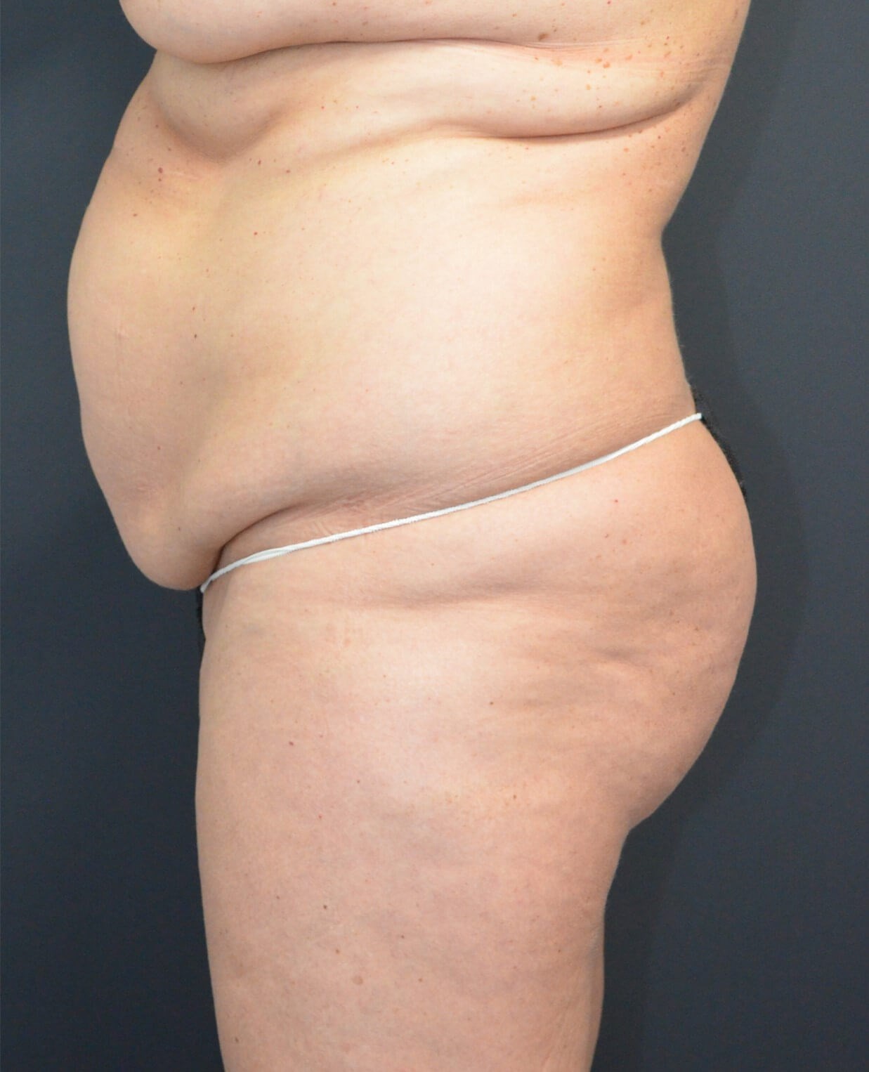 Lipo360 and Lipoabdominoplasty Before