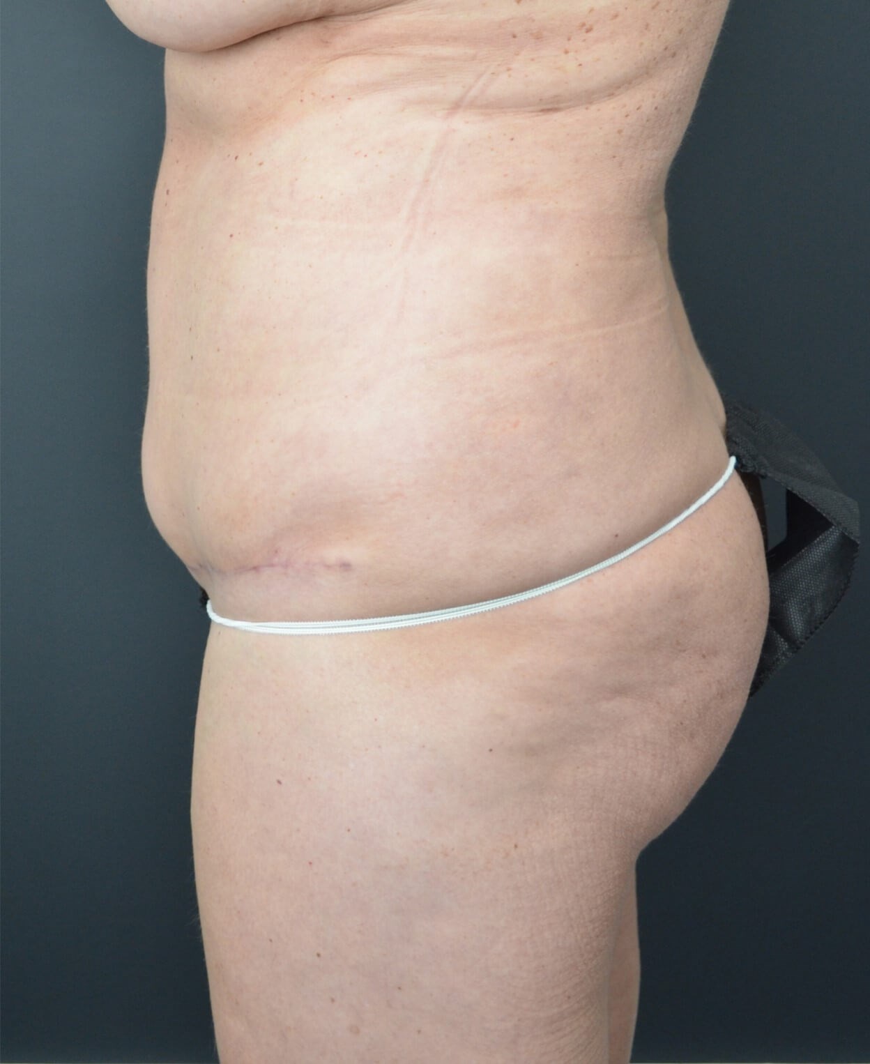 Lipo360 and Lipoabdominoplasty After