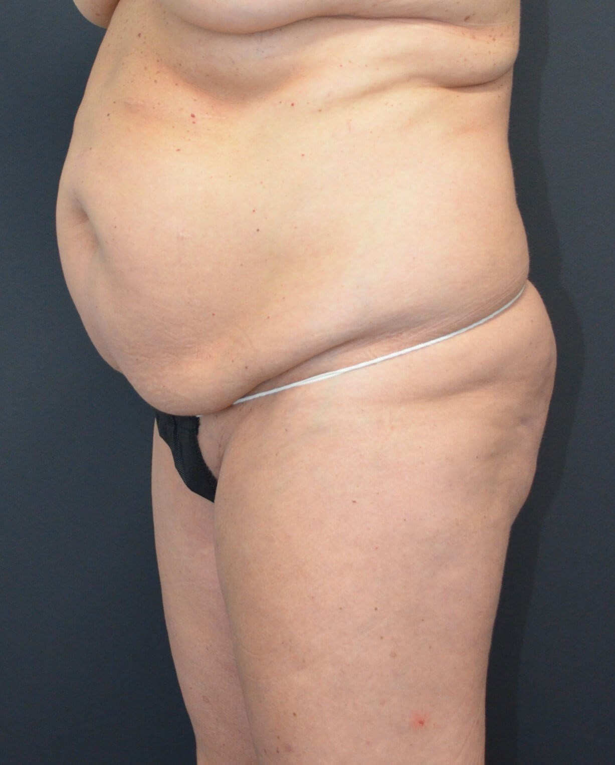 Lipo360 and Lipoabdominoplasty Before
