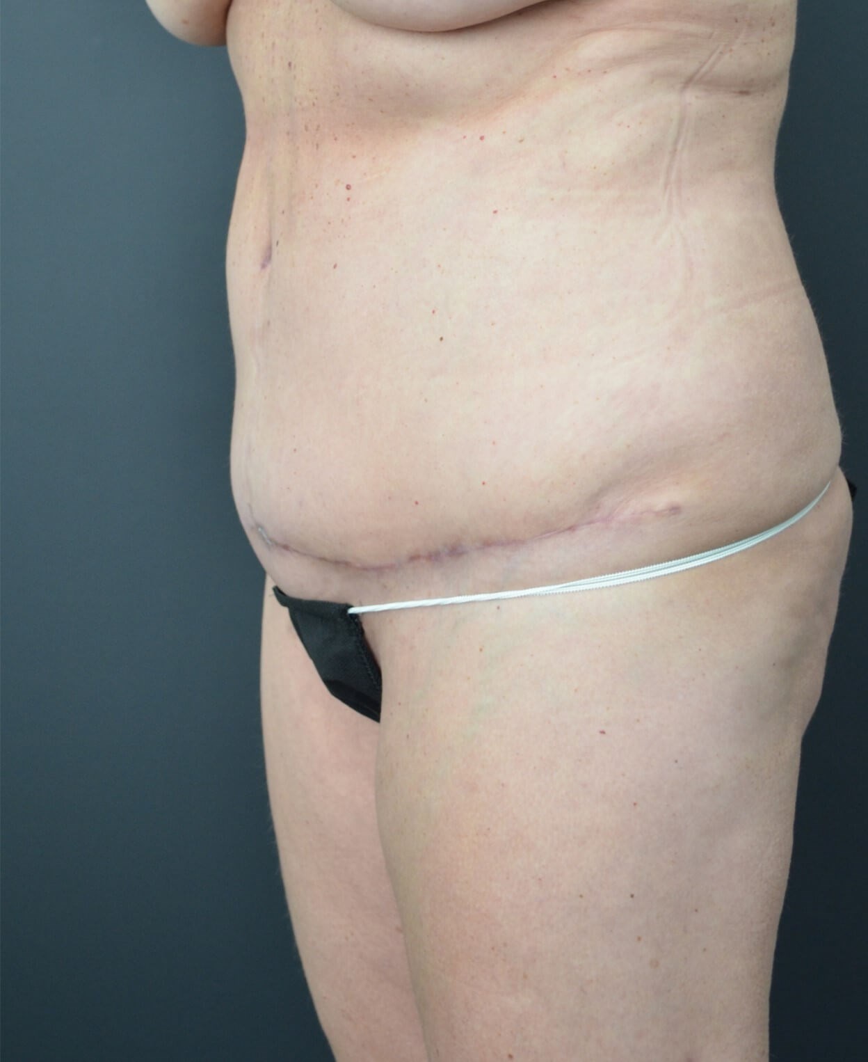 Lipo360 and Lipoabdominoplasty After
