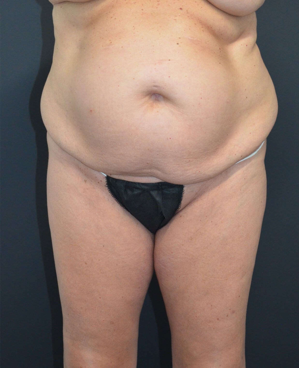 Lipo360 and Lipoabdominoplasty Before