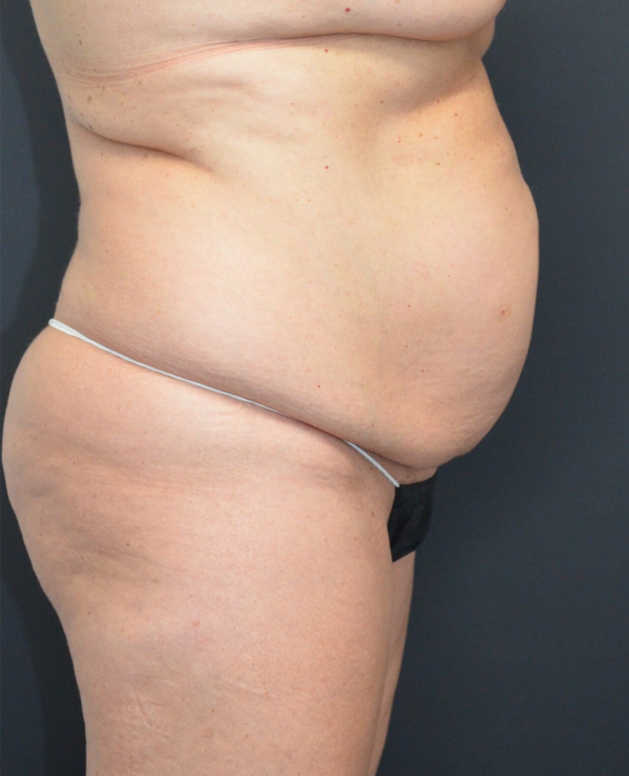 Lipo360 and Lipoabdominoplasty Before