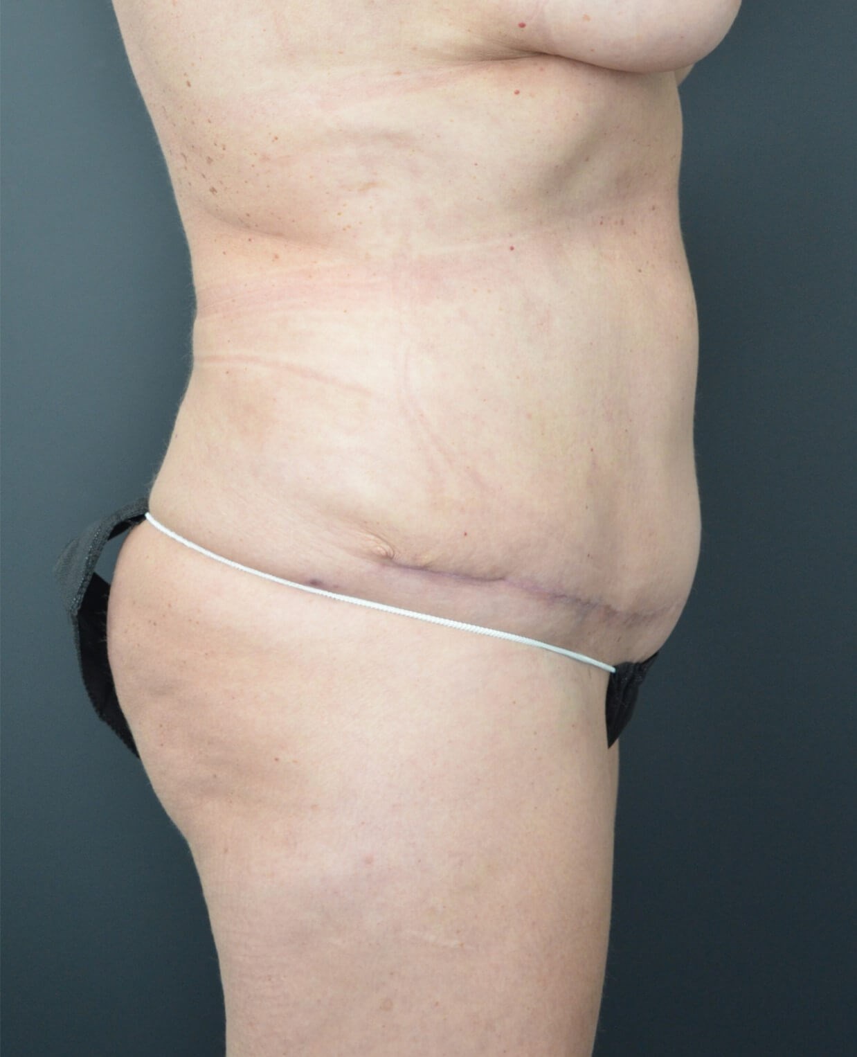 Lipo360 and Lipoabdominoplasty After