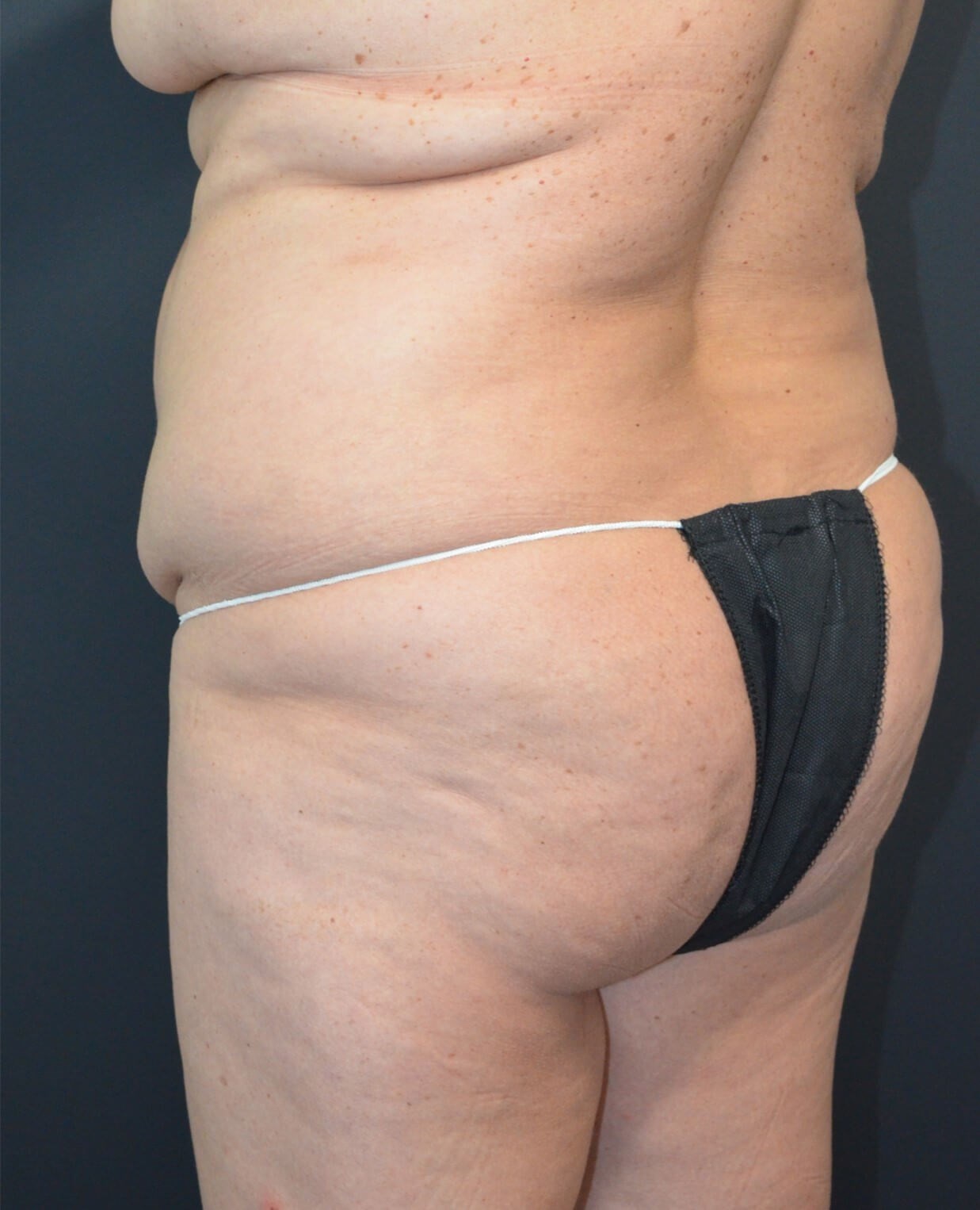Lipo360 and Lipoabdominoplasty Before