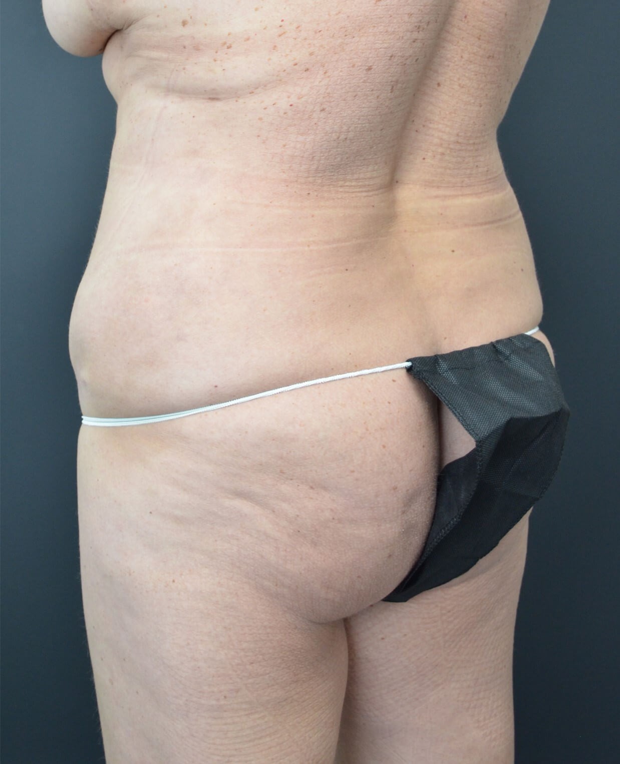Lipo360 and Lipoabdominoplasty After