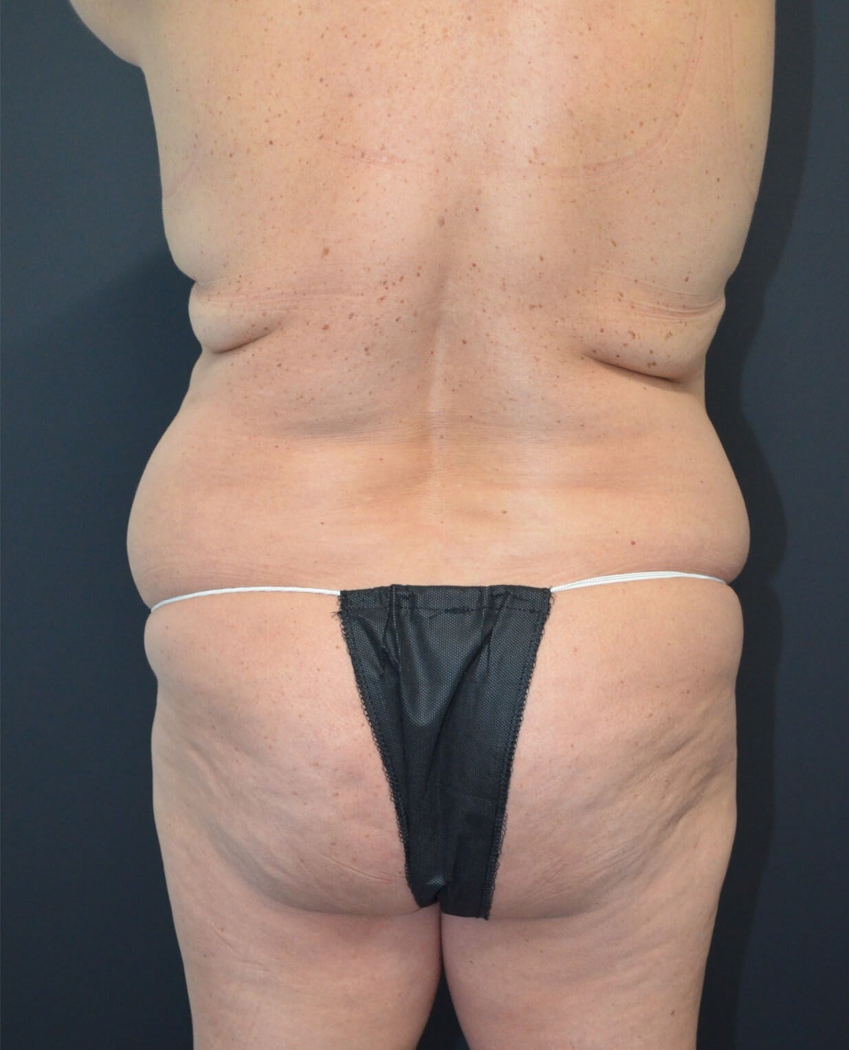 Lipo360 and Lipoabdominoplasty Before