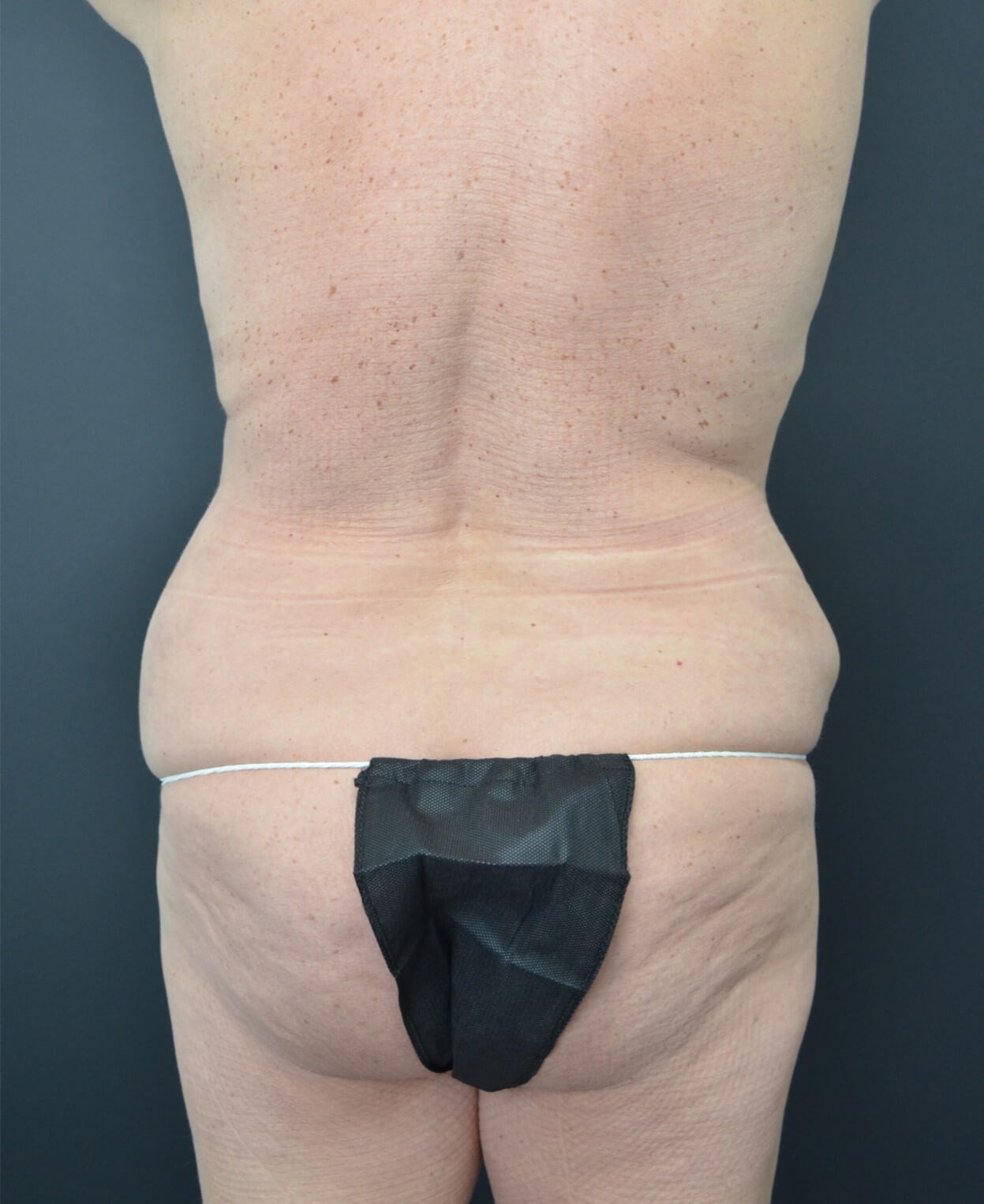 Lipo360 and Lipoabdominoplasty After