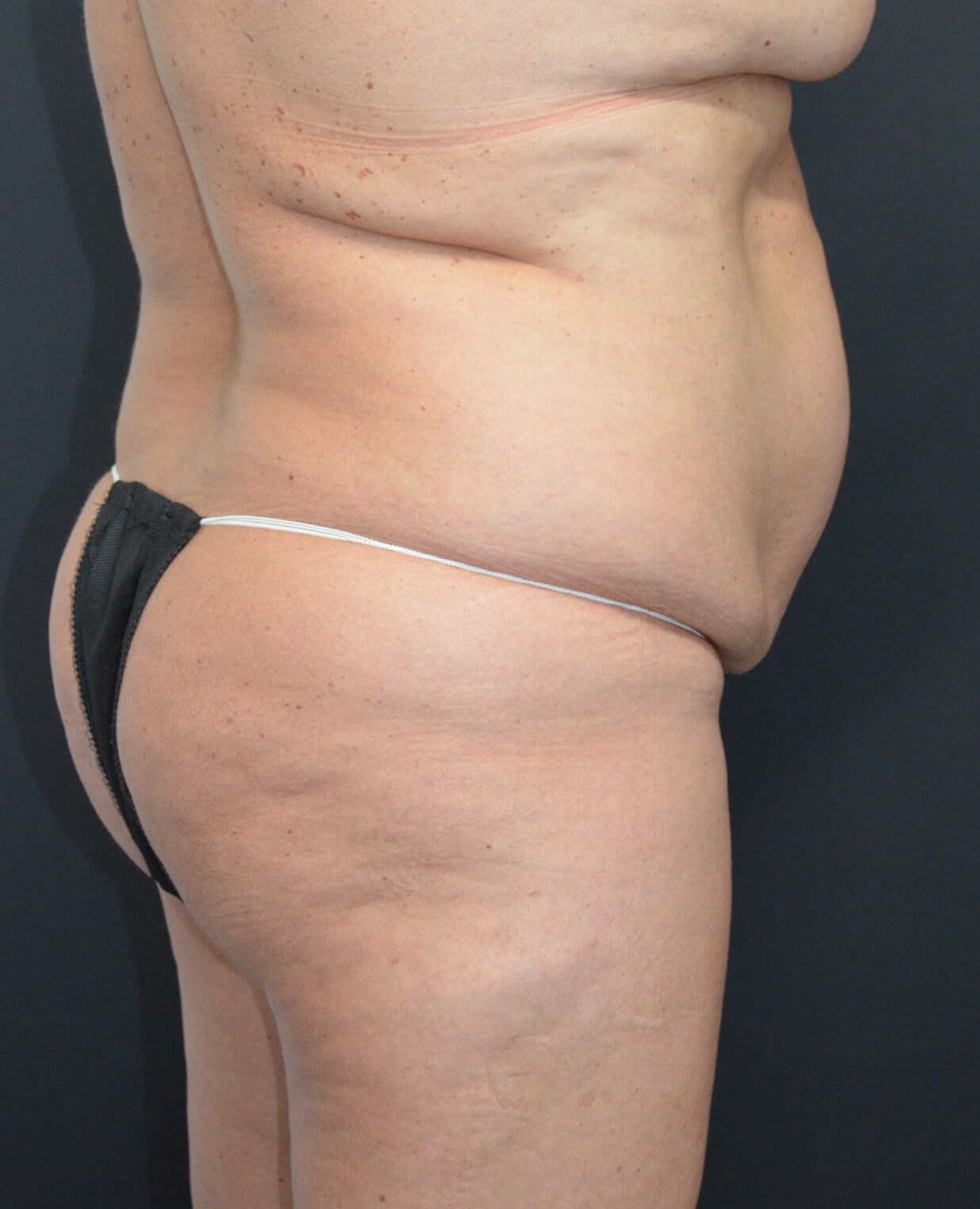 Lipo360 and Lipoabdominoplasty Before