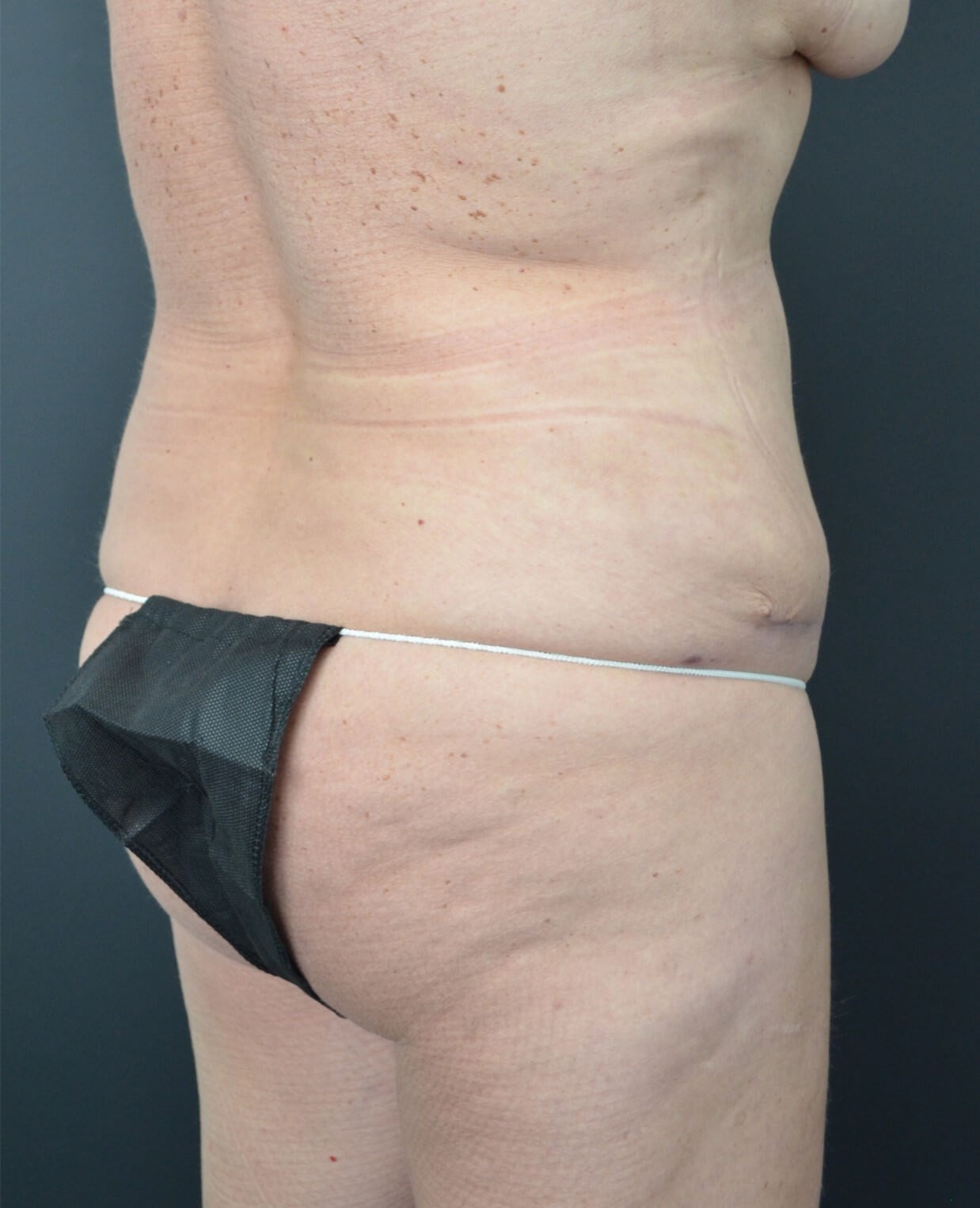 Lipo360 and Lipoabdominoplasty After