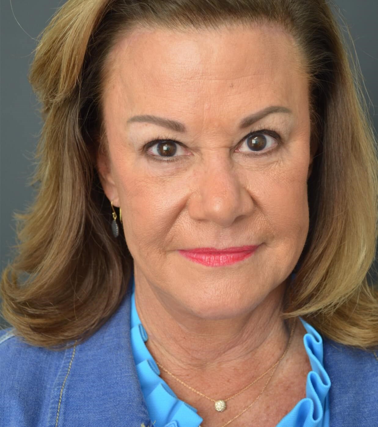 Facelift, necklift, browlift After