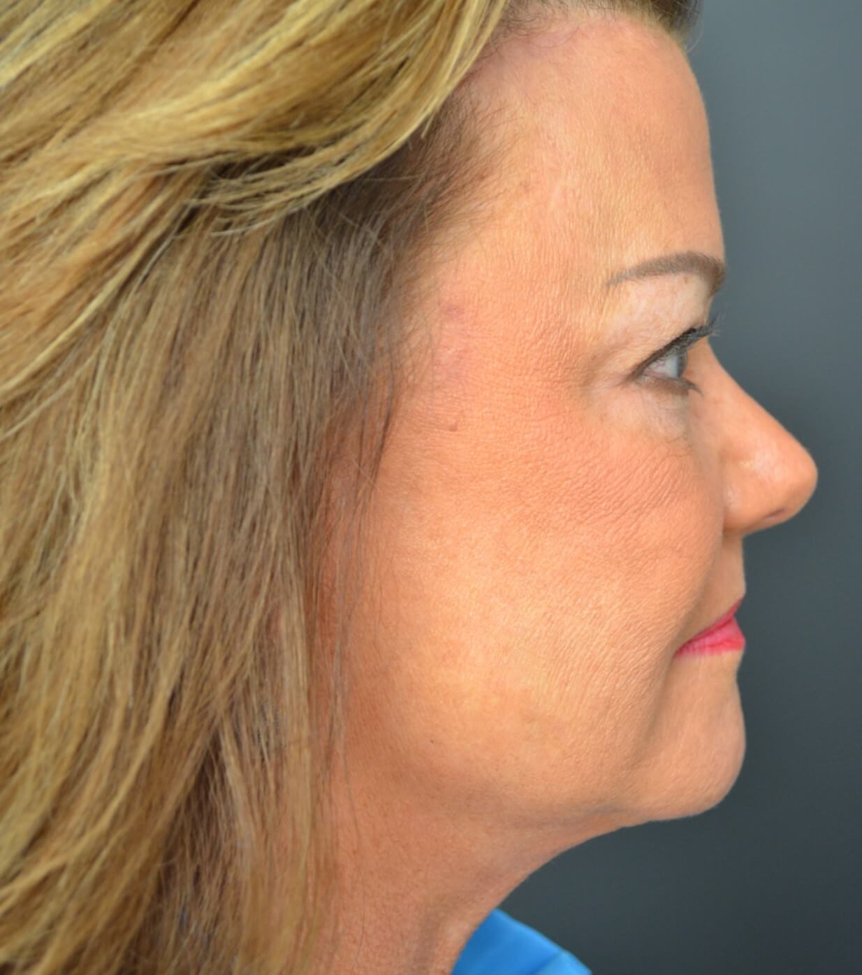 Facelift, necklift, browlift After