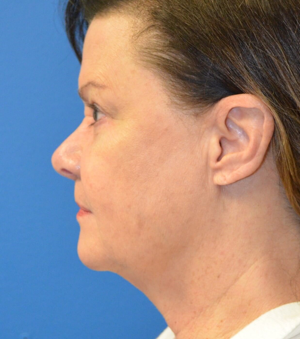 Facelift, necklift, browlift Before