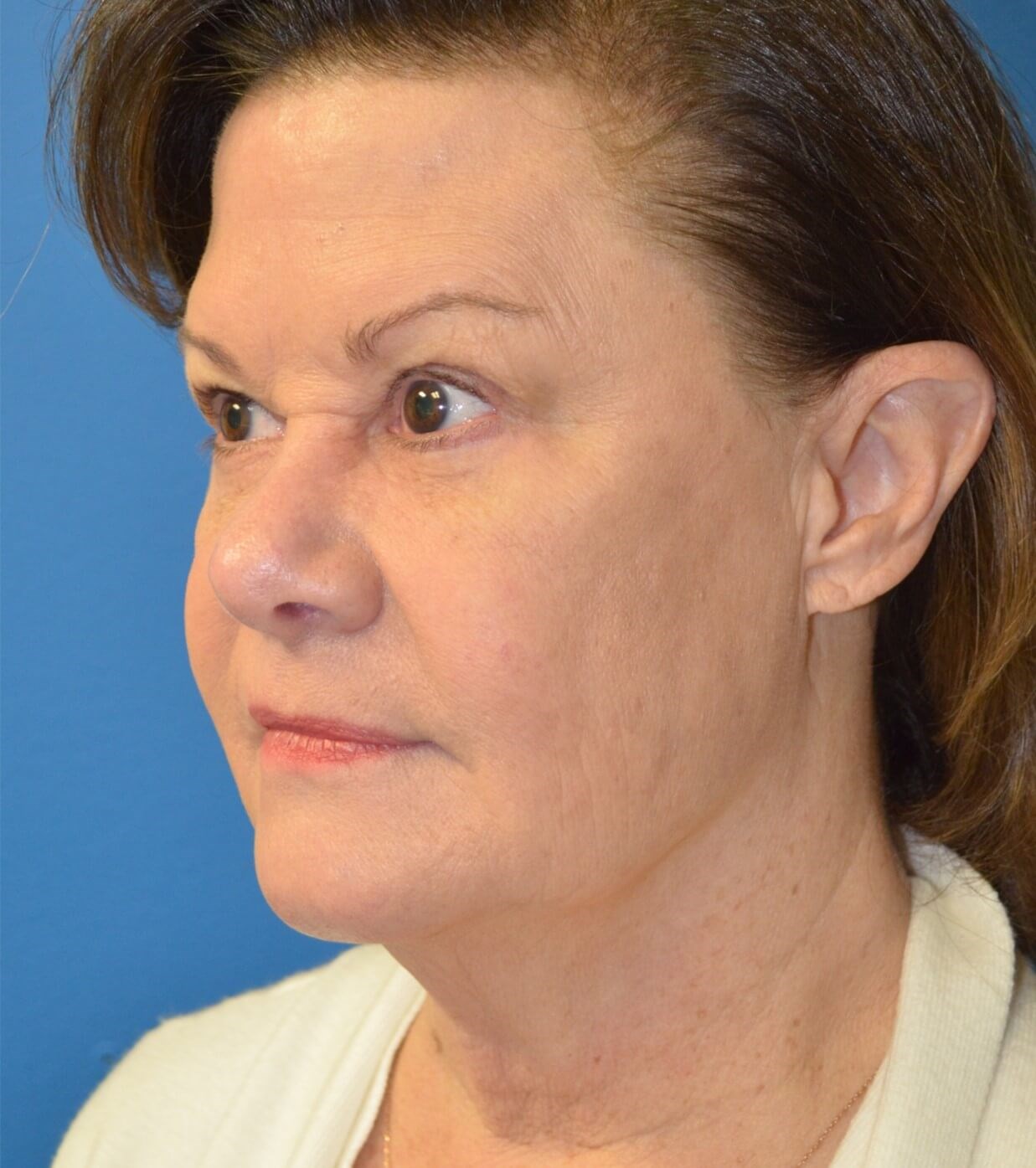 Facelift, necklift, browlift Before