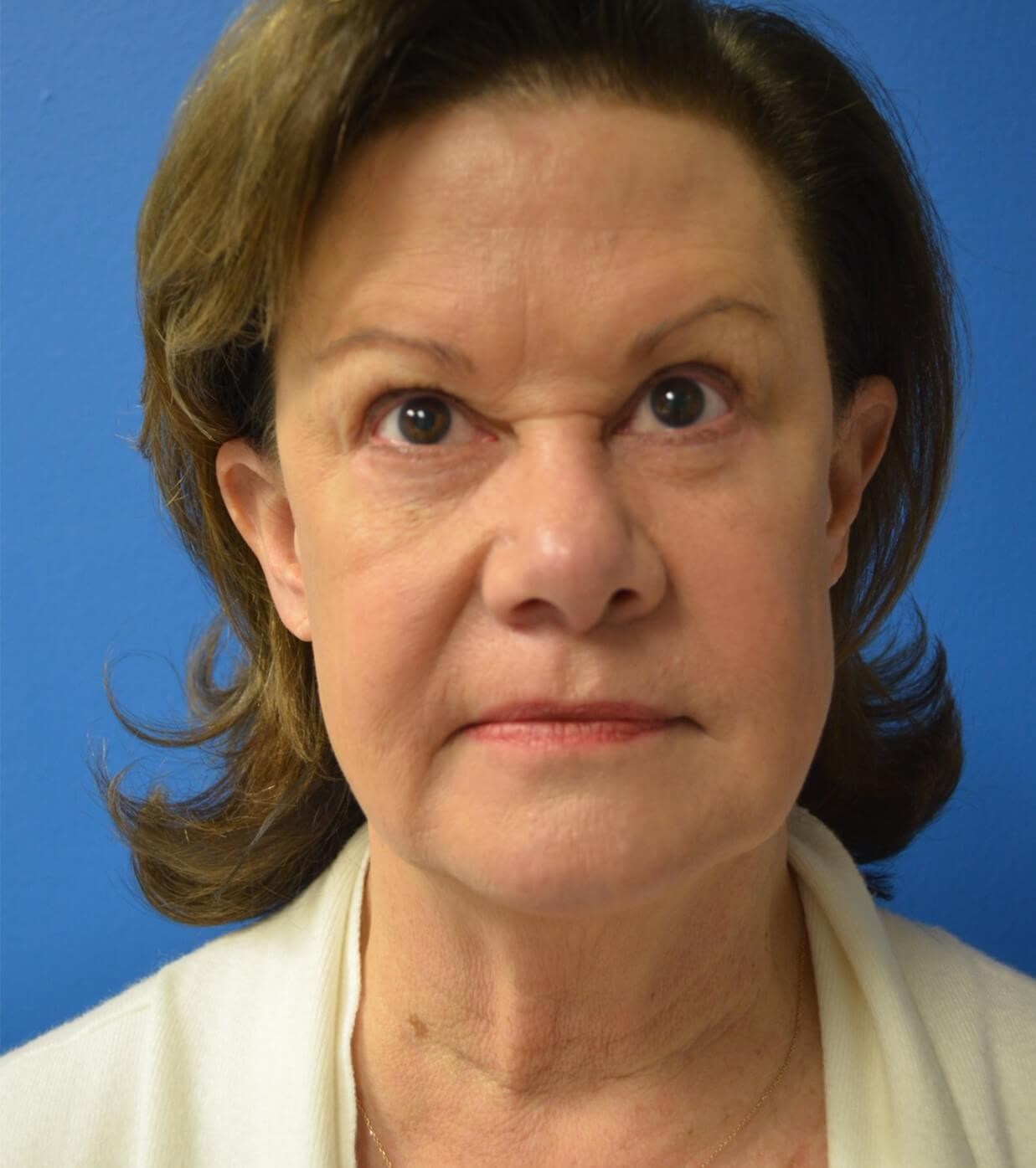 Facelift, necklift, browlift Before
