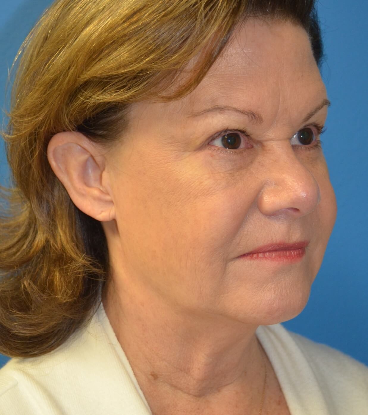 Facelift, necklift, browlift Before
