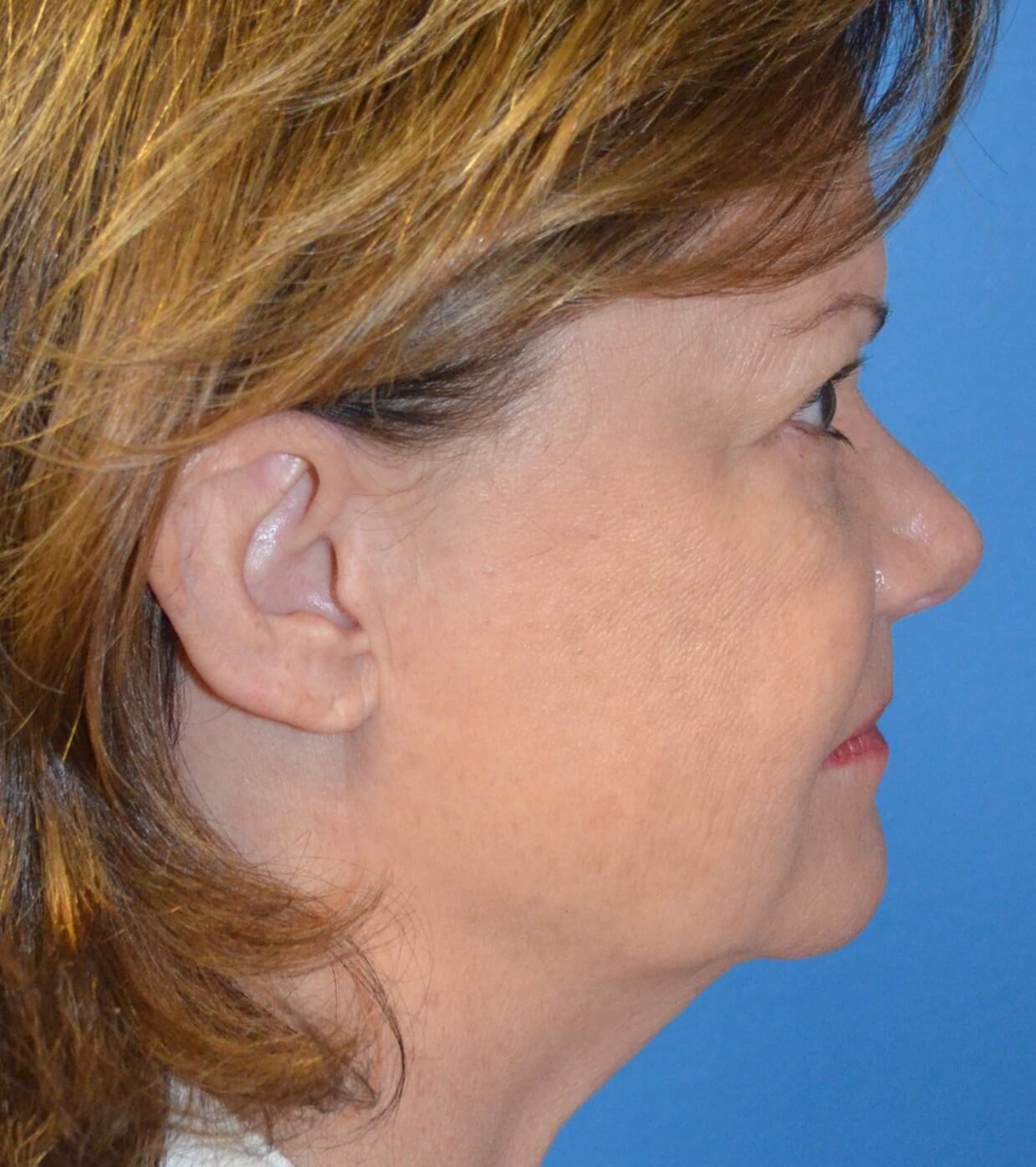 Facelift, necklift, browlift Before