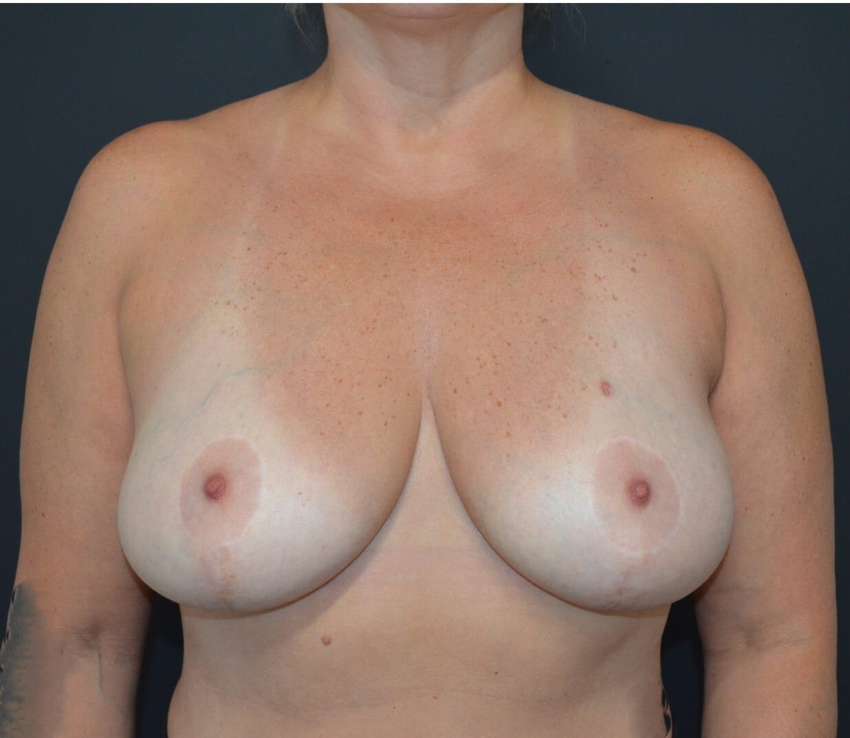 Breast Aug/Lift Internal Bra Before