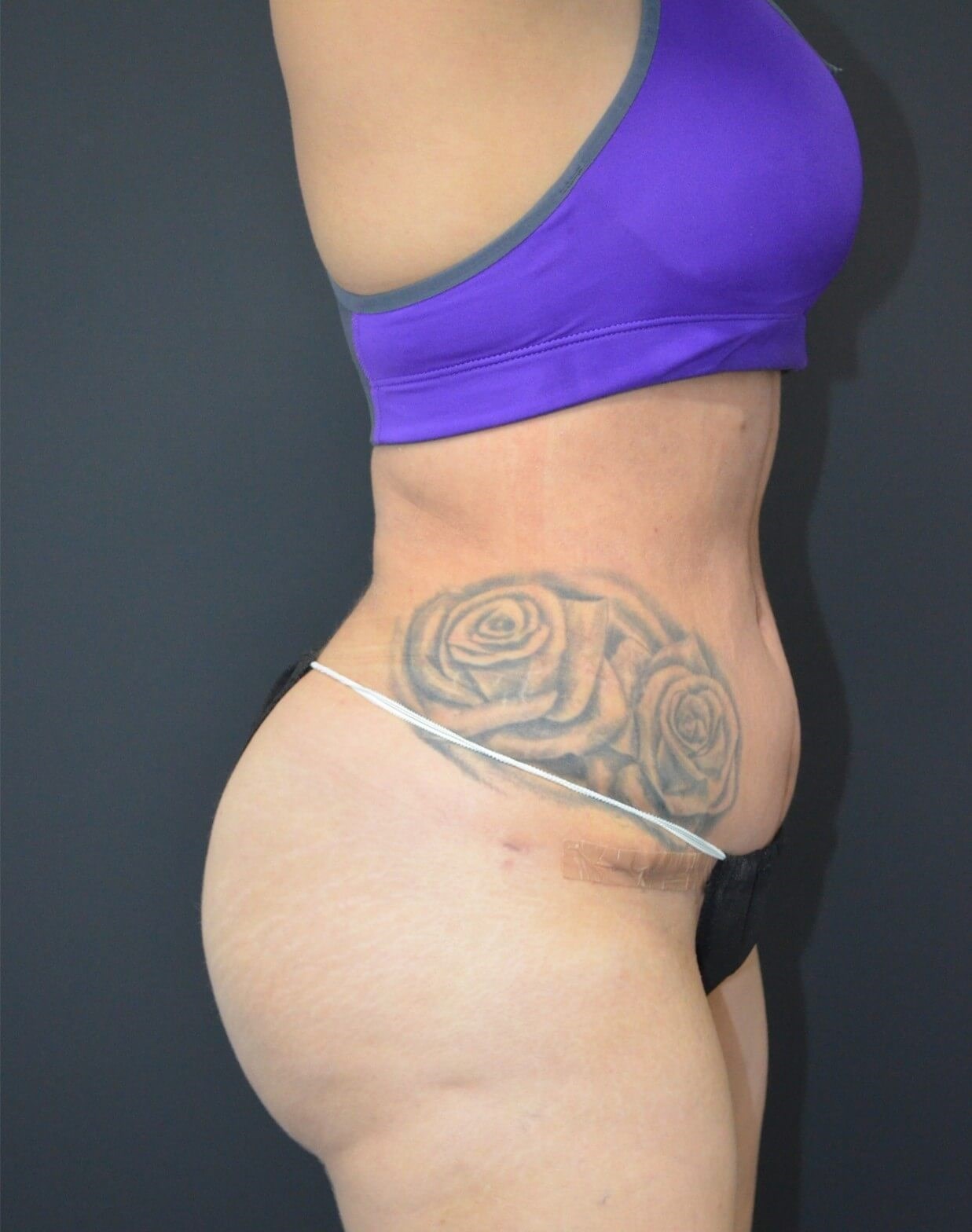 BBL, Tummy Tuck, Vaser Lipo360 After