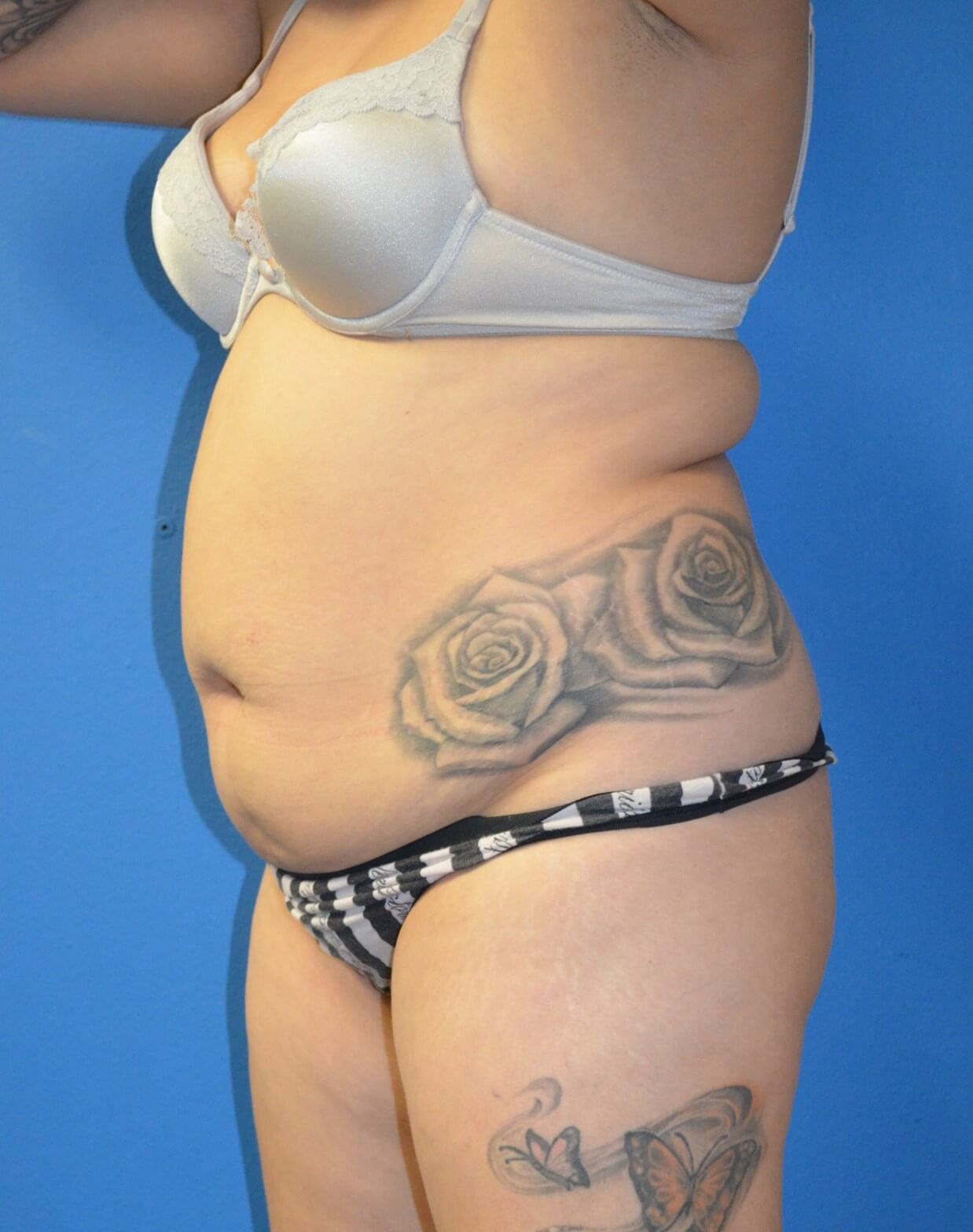 BBL, Tummy Tuck, Vaser Lipo360 Before