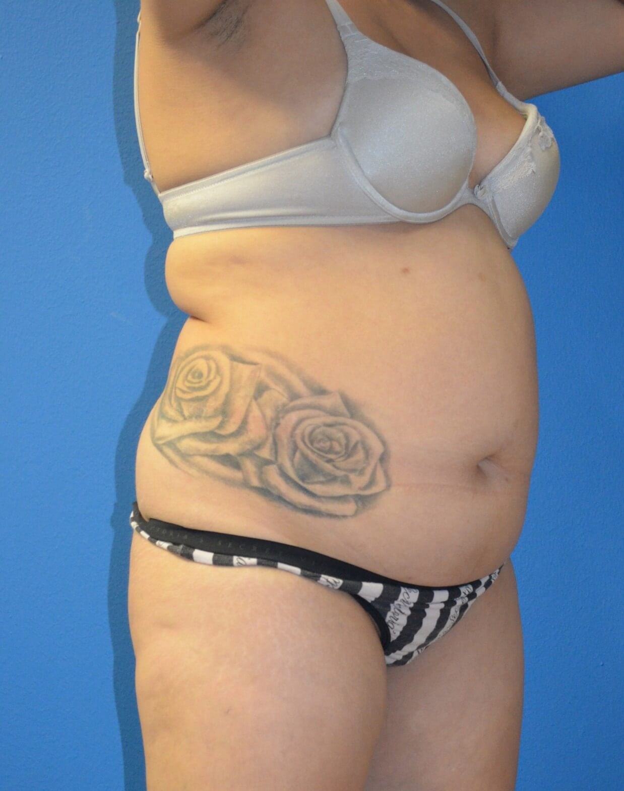 BBL, Tummy Tuck, Vaser Lipo360 Before