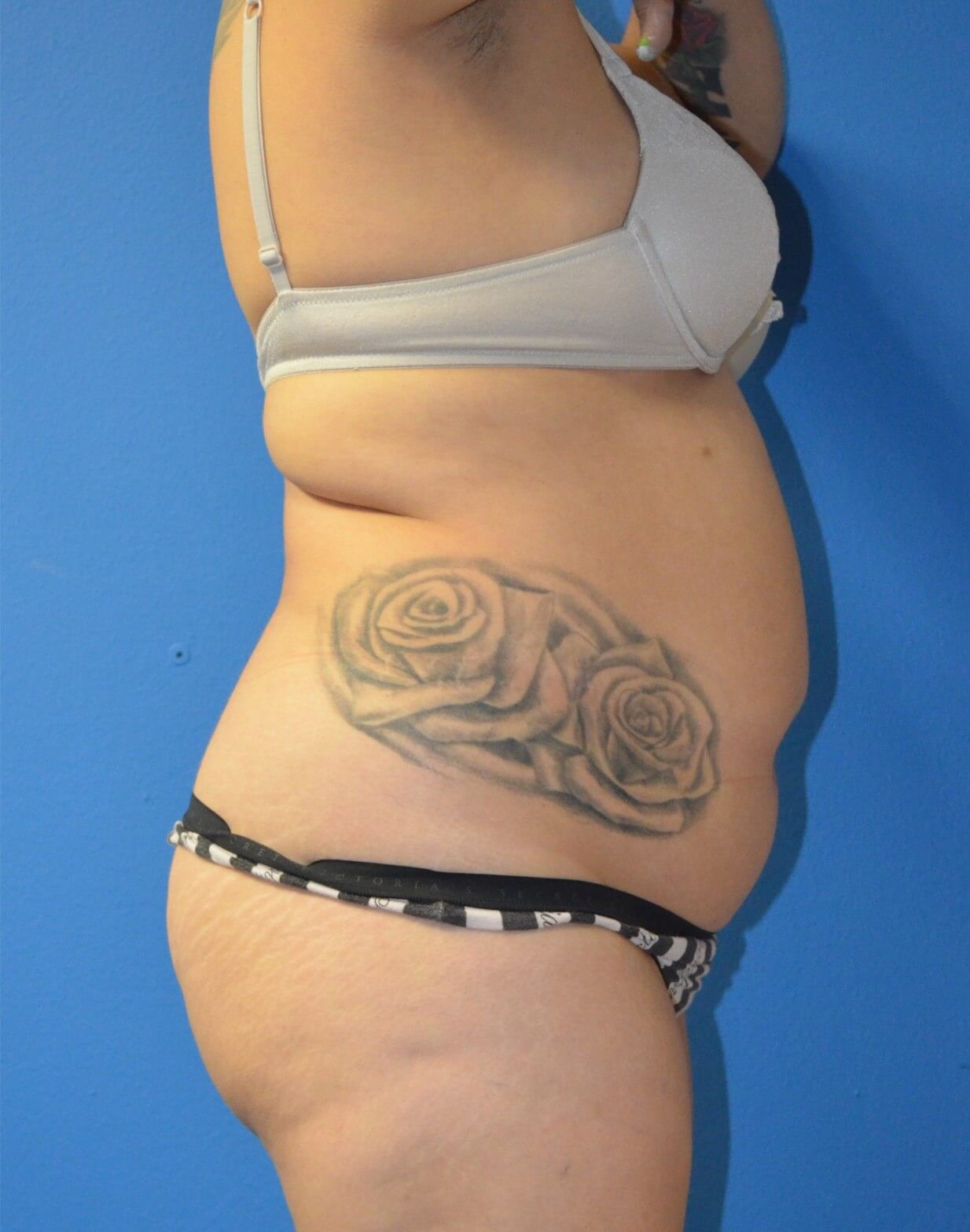 BBL, Tummy Tuck, Vaser Lipo360 Before