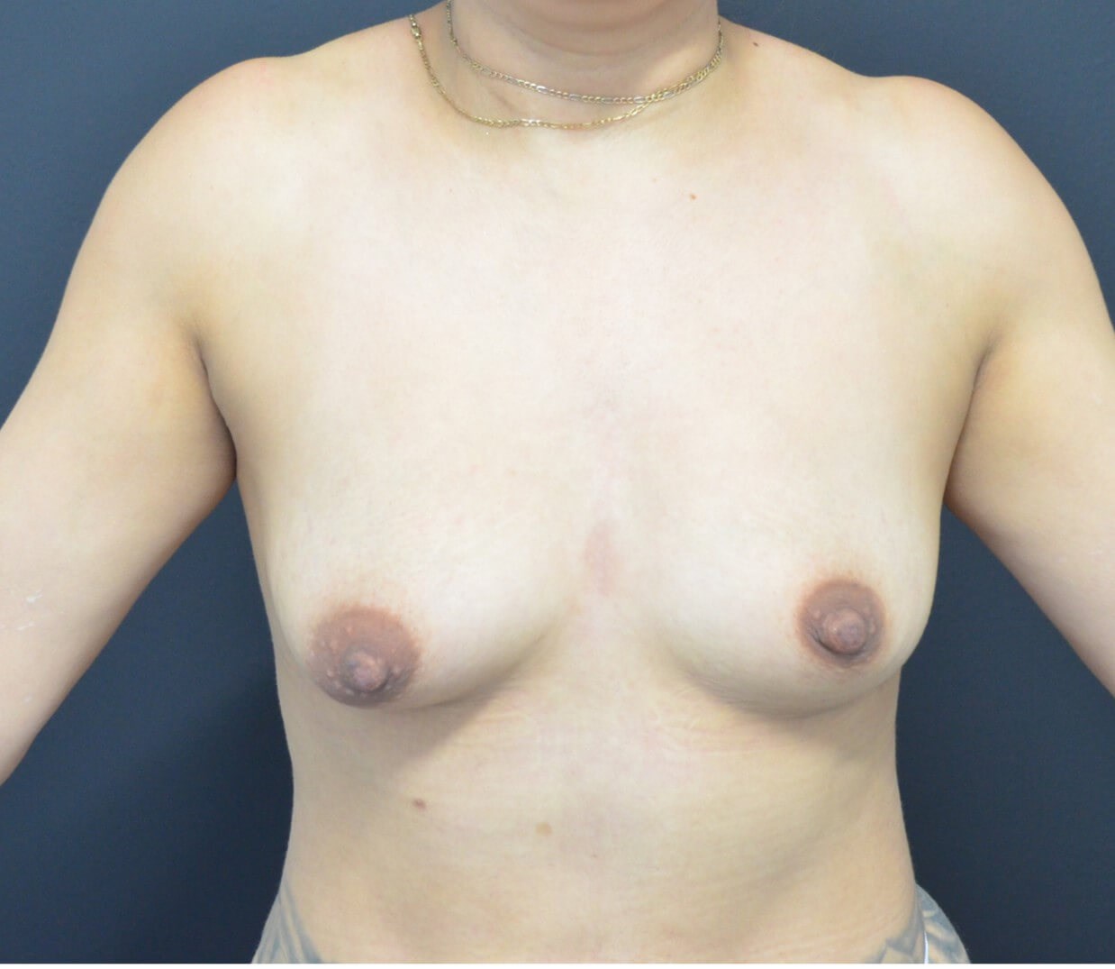 Breast Augmentation 385 Mod + Before