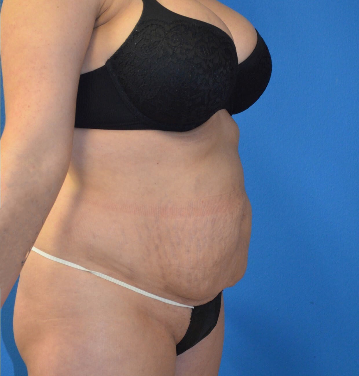 Lipoabdominoplasty and Lipo360 Before