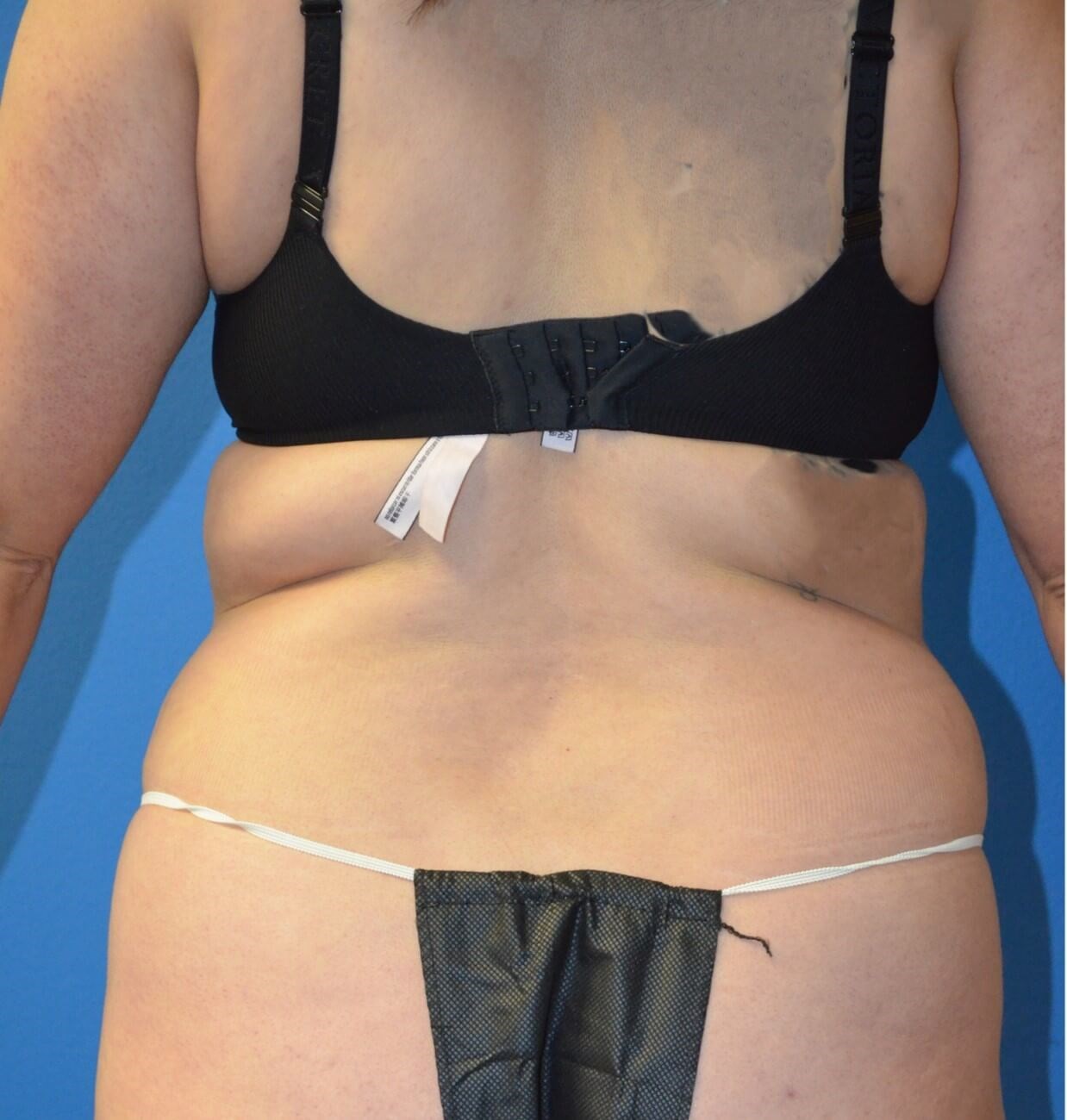 Lipoabdominoplasty and Lipo360 Before