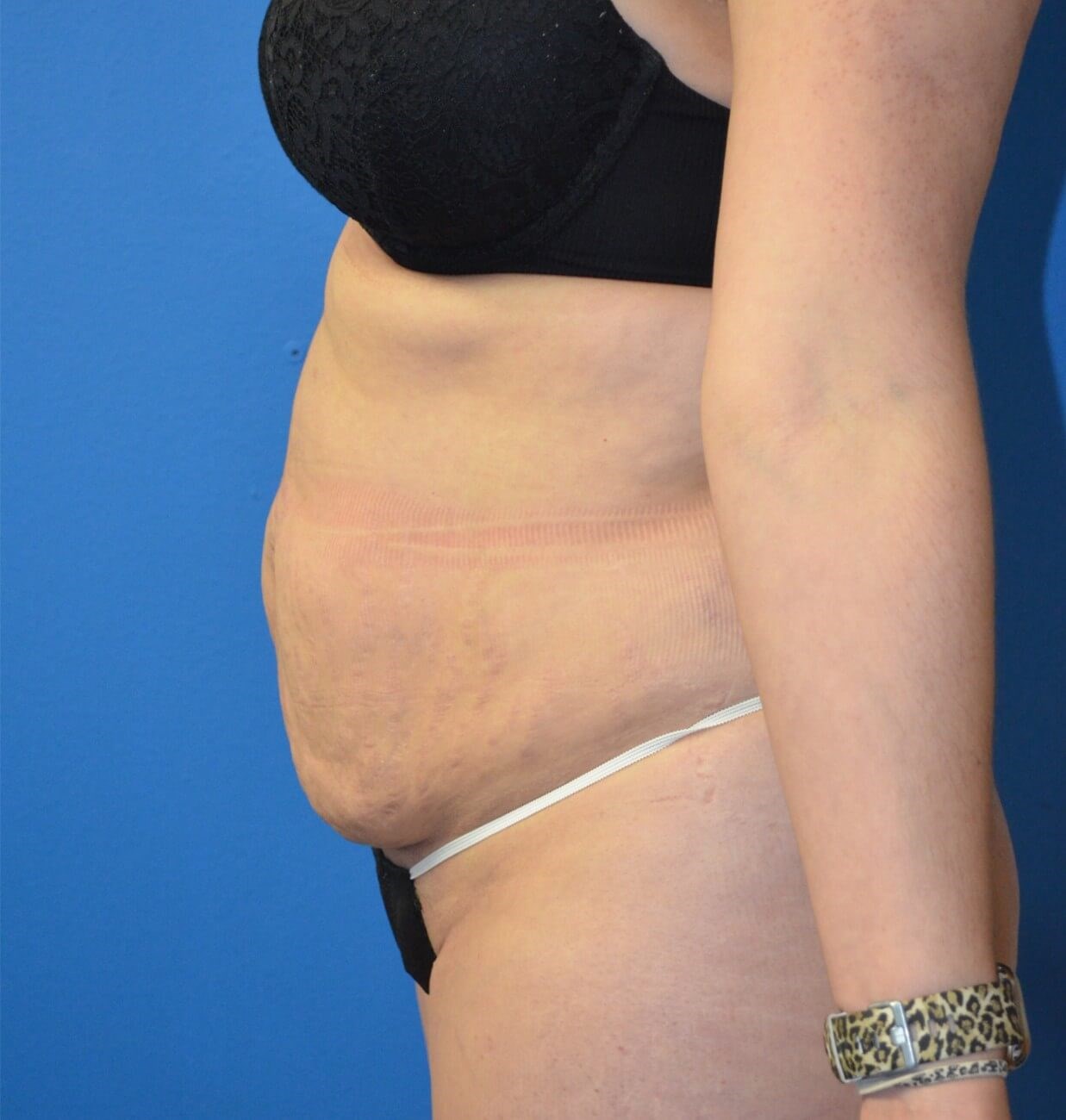 Lipoabdominoplasty and Lipo360 Before