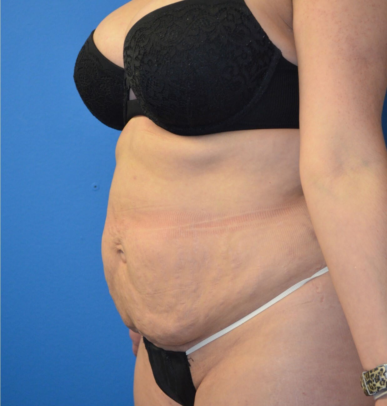 Lipoabdominoplasty and Lipo360 Before