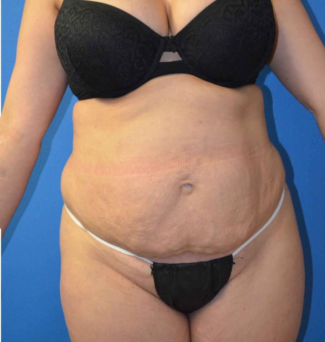 Lipoabdominoplasty and Lipo360 Before