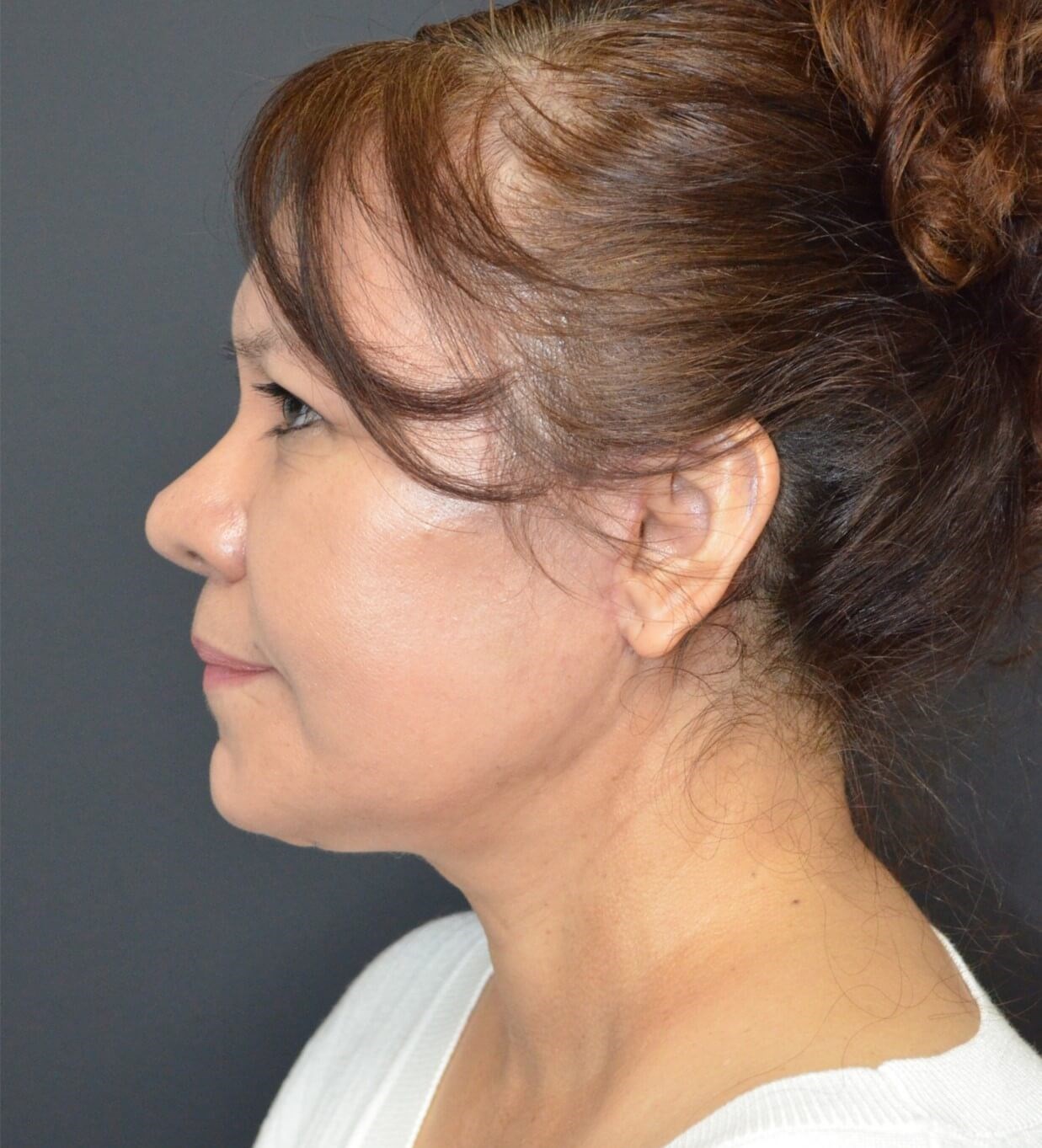 Deep plane face and necklift After