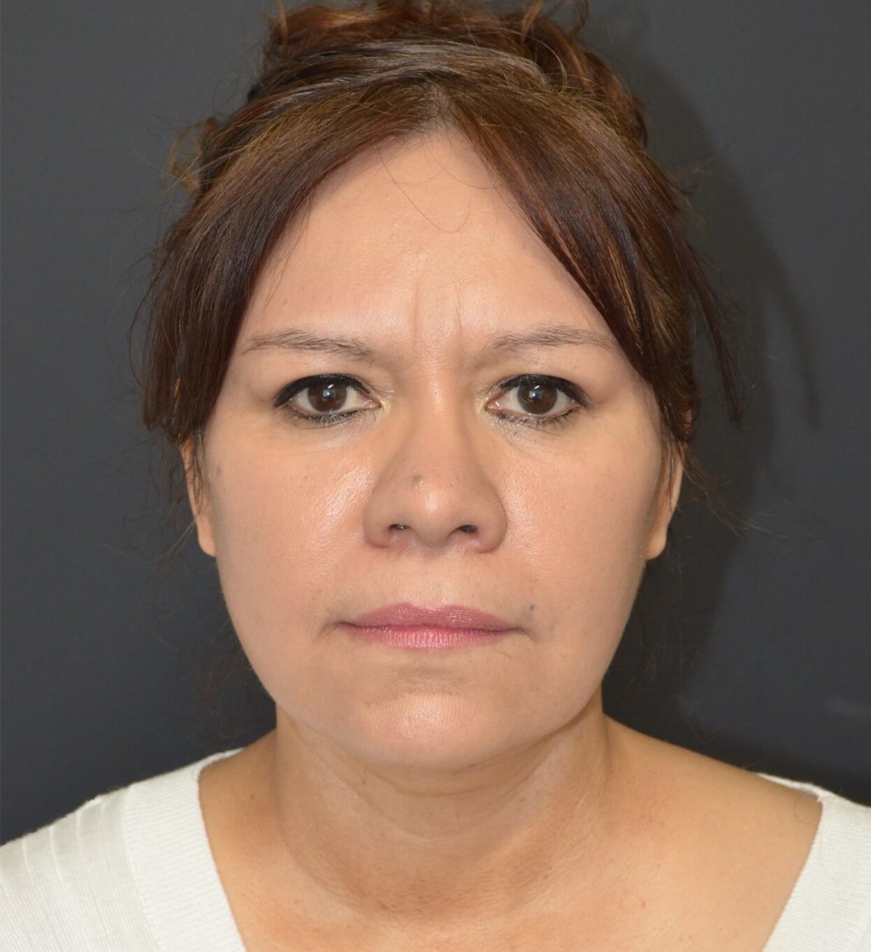 Deep plane face and necklift After