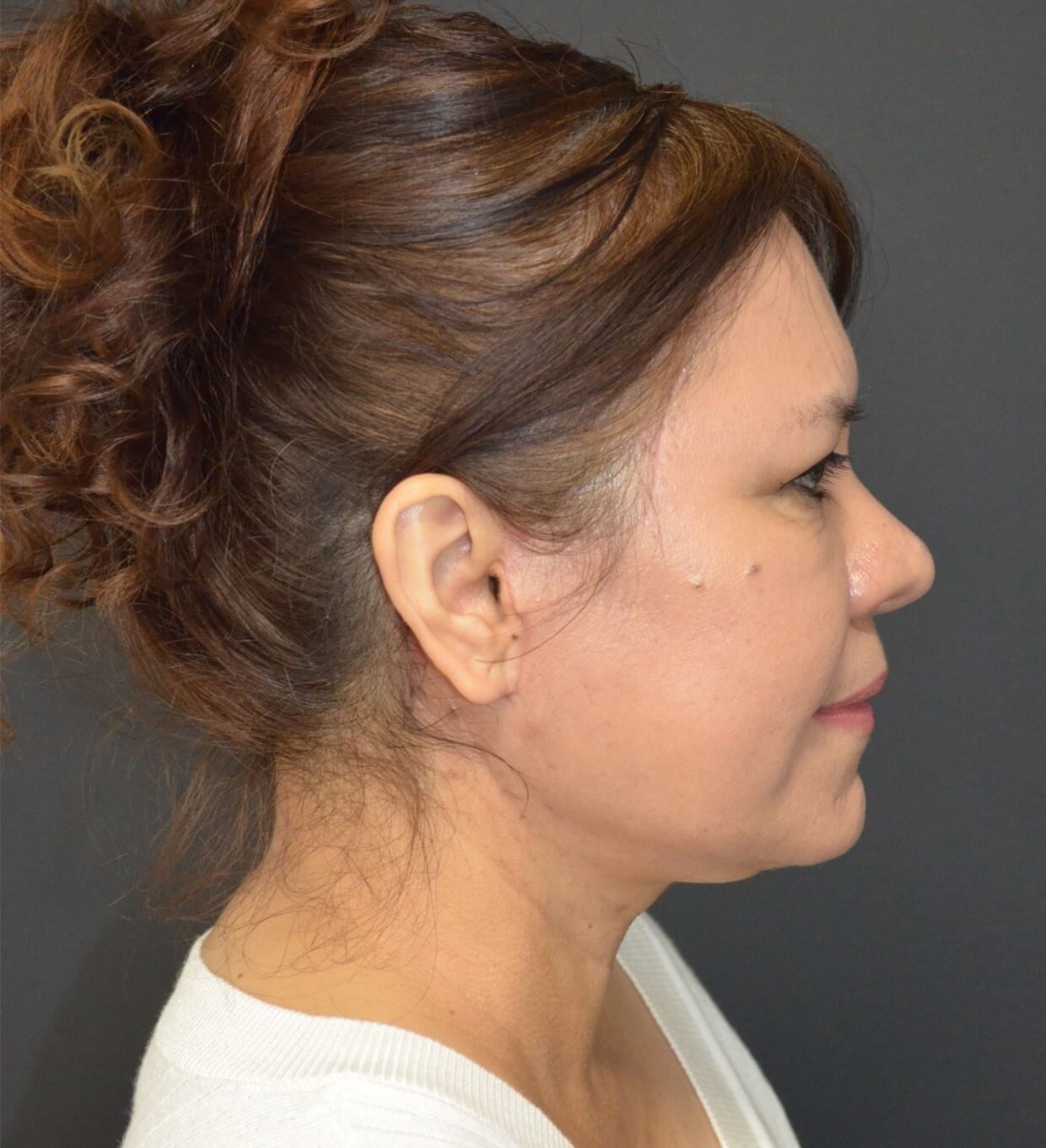 Deep plane face and necklift After