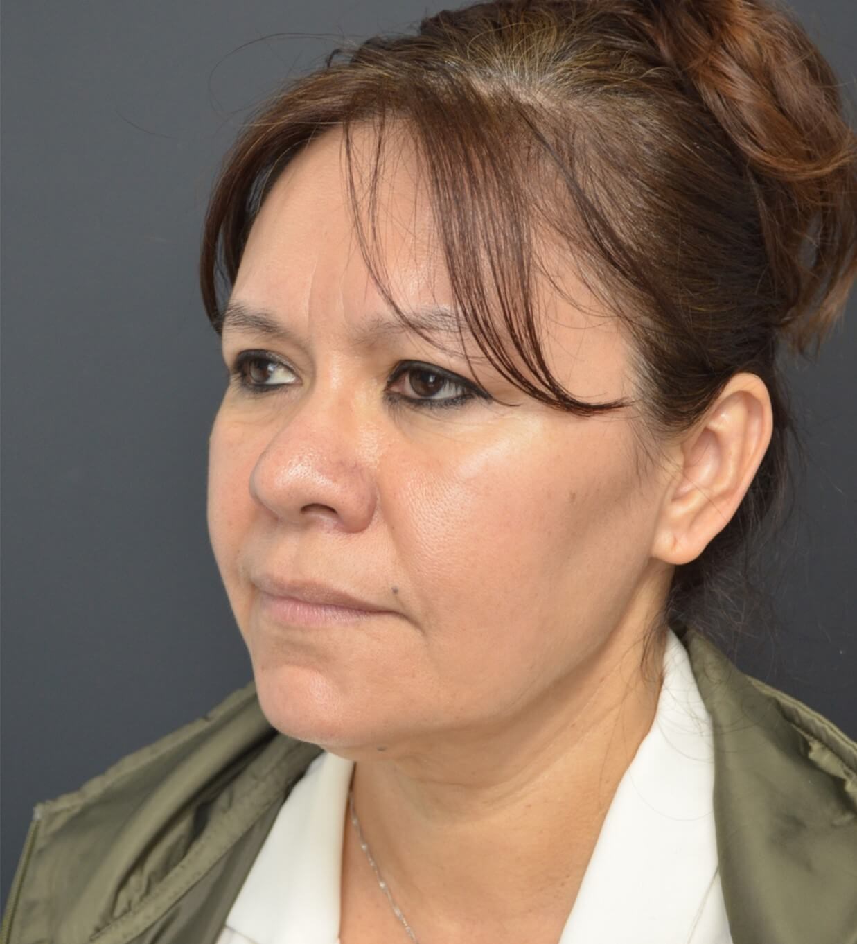 Deep plane face and necklift Before