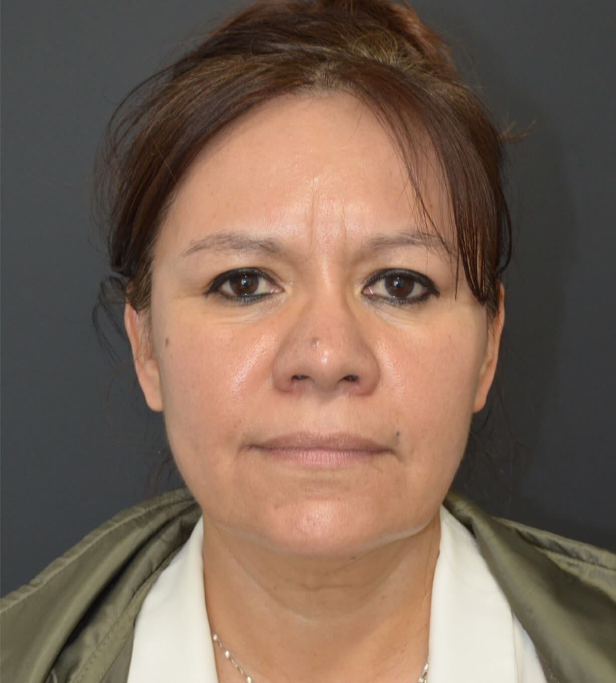 Deep plane face and necklift Before