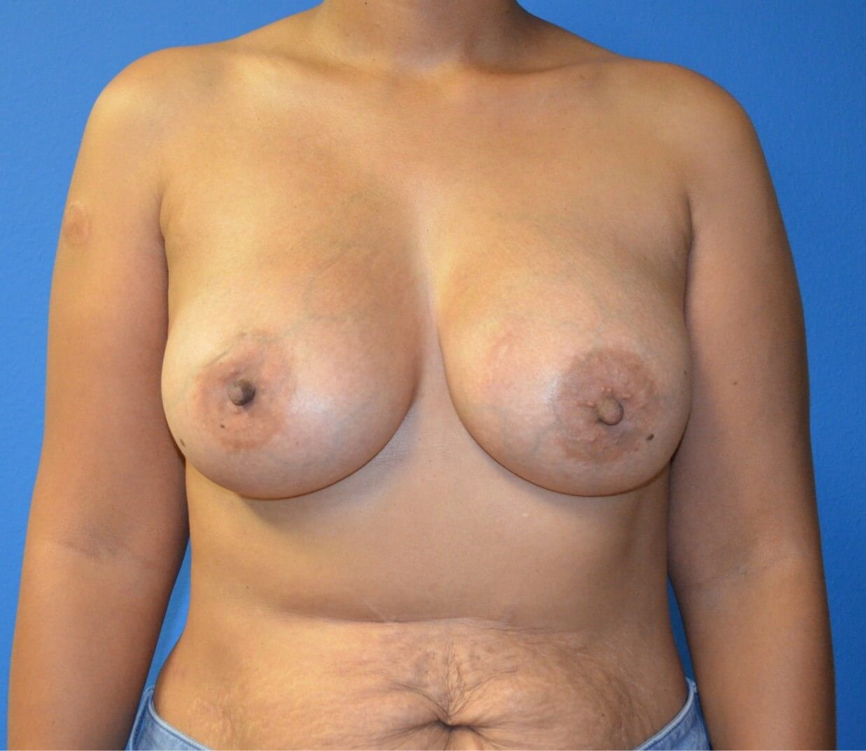 Breast Augmentation 395 cc mod After