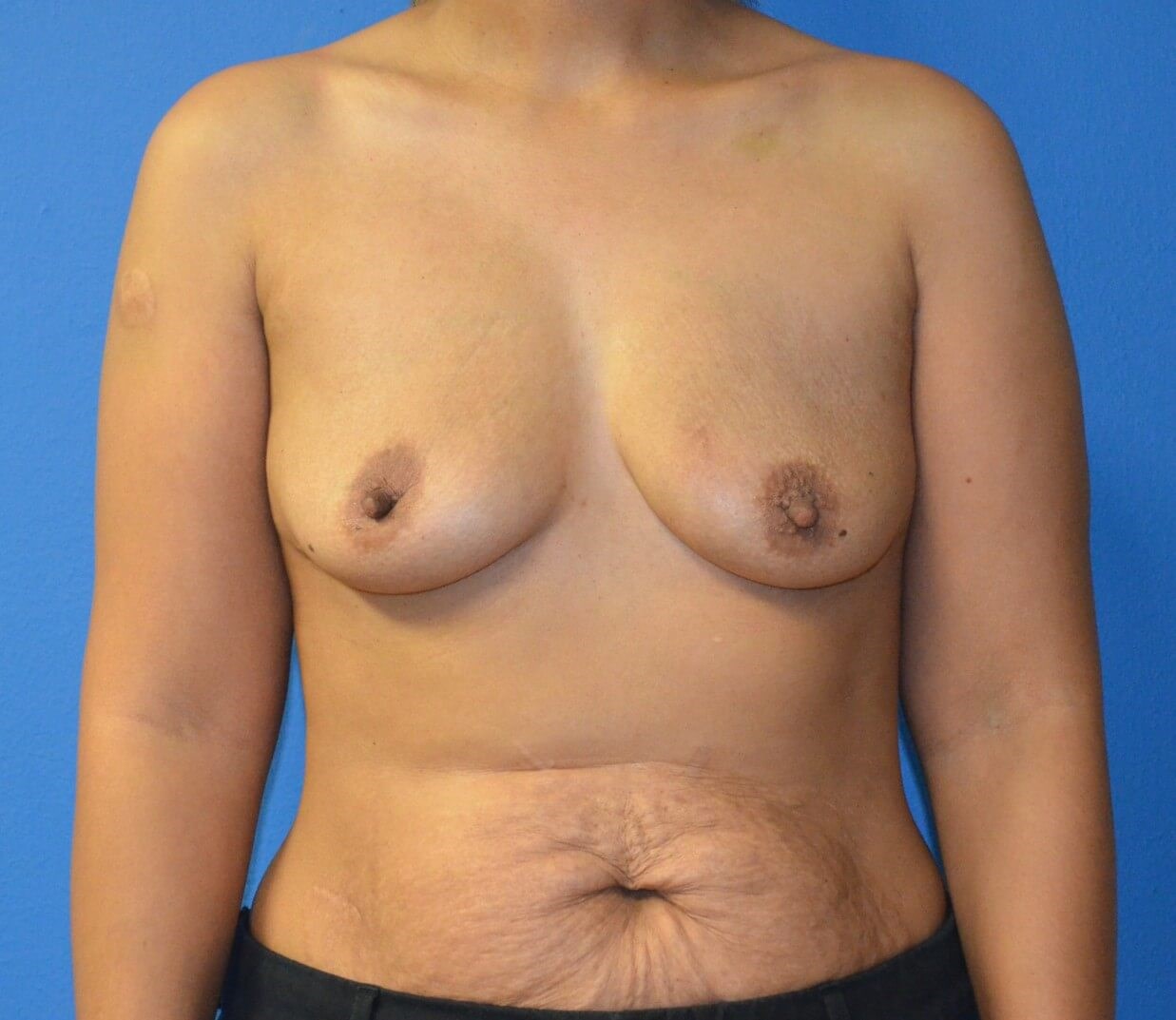 Breast Augmentation 395 cc mod Before