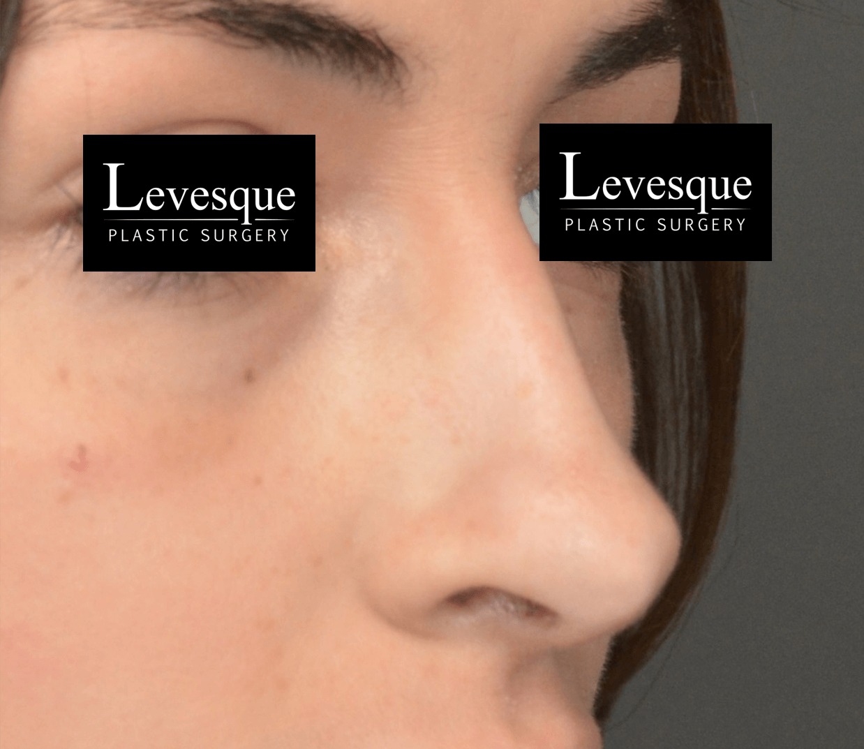 Open Rhinoplasty After