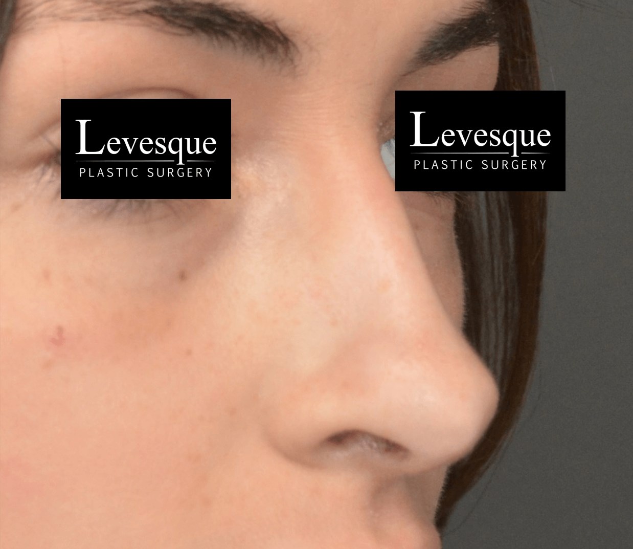 Open Rhinoplasty After