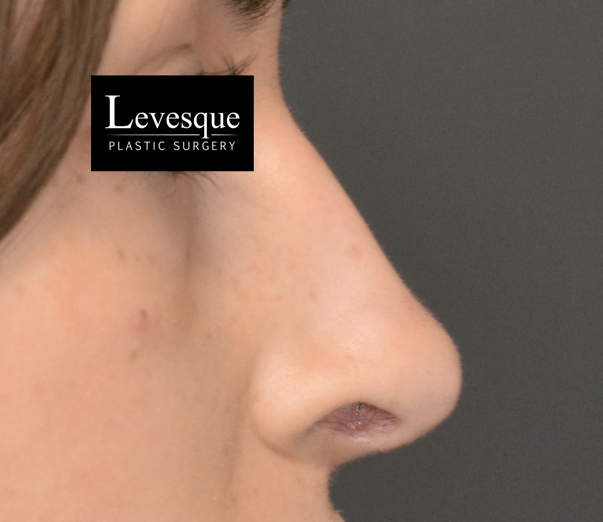 Open Rhinoplasty After
