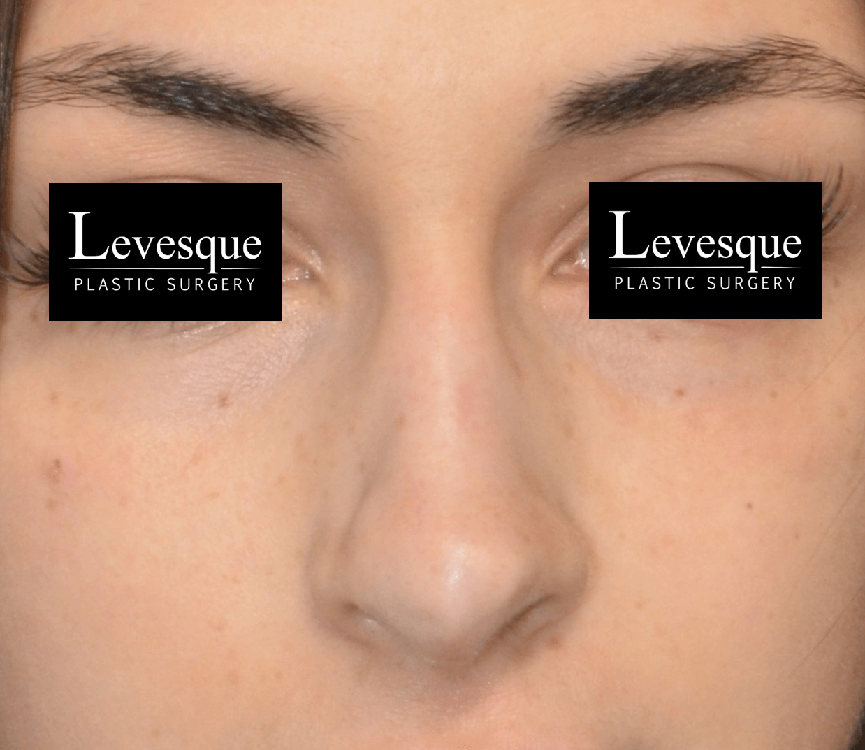 Open Rhinoplasty After