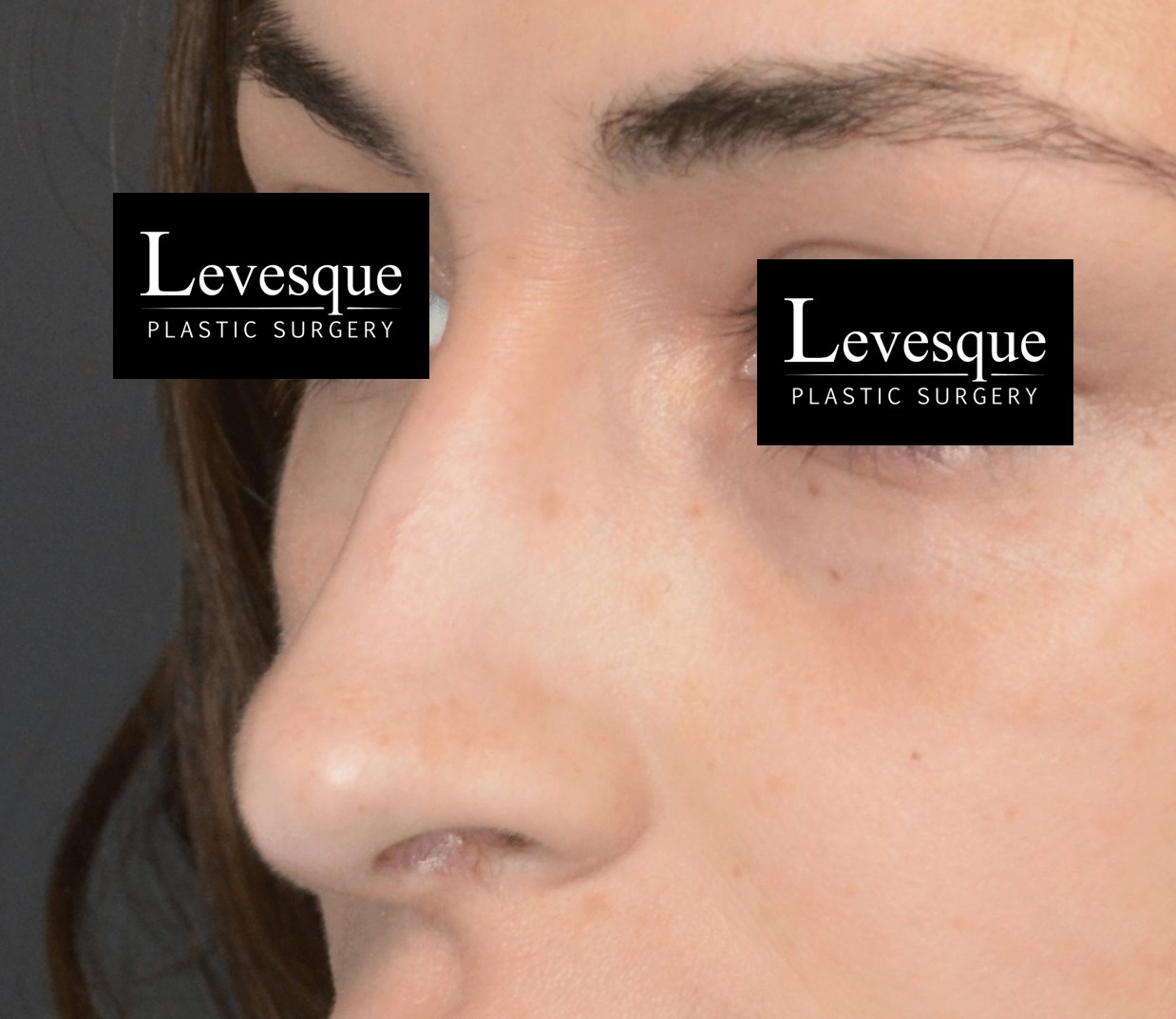Open Rhinoplasty After