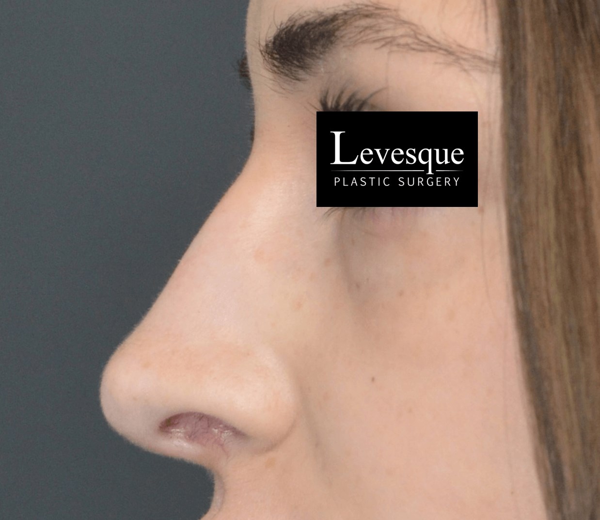 Open Rhinoplasty After