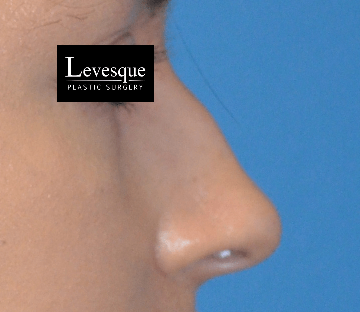 Open Rhinoplasty Before