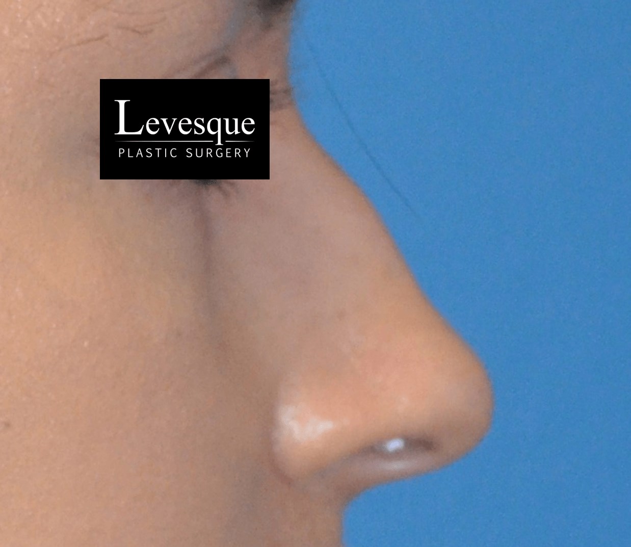 Open Rhinoplasty Before